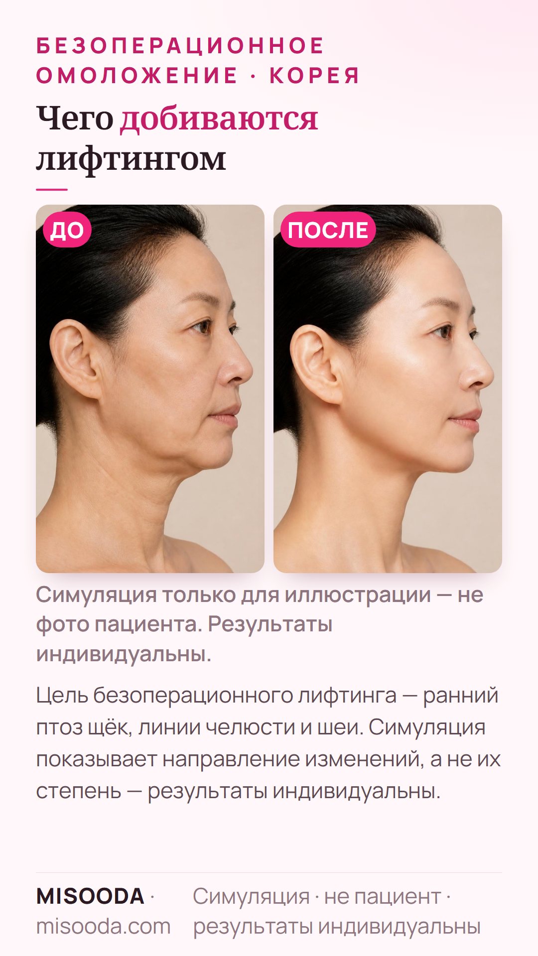 Иллюстрация типичных целей безоперационного лифтинга в Корее — ранний птоз щёк, линии челюсти и шеи — симуляция на модели, не пациент; только направление