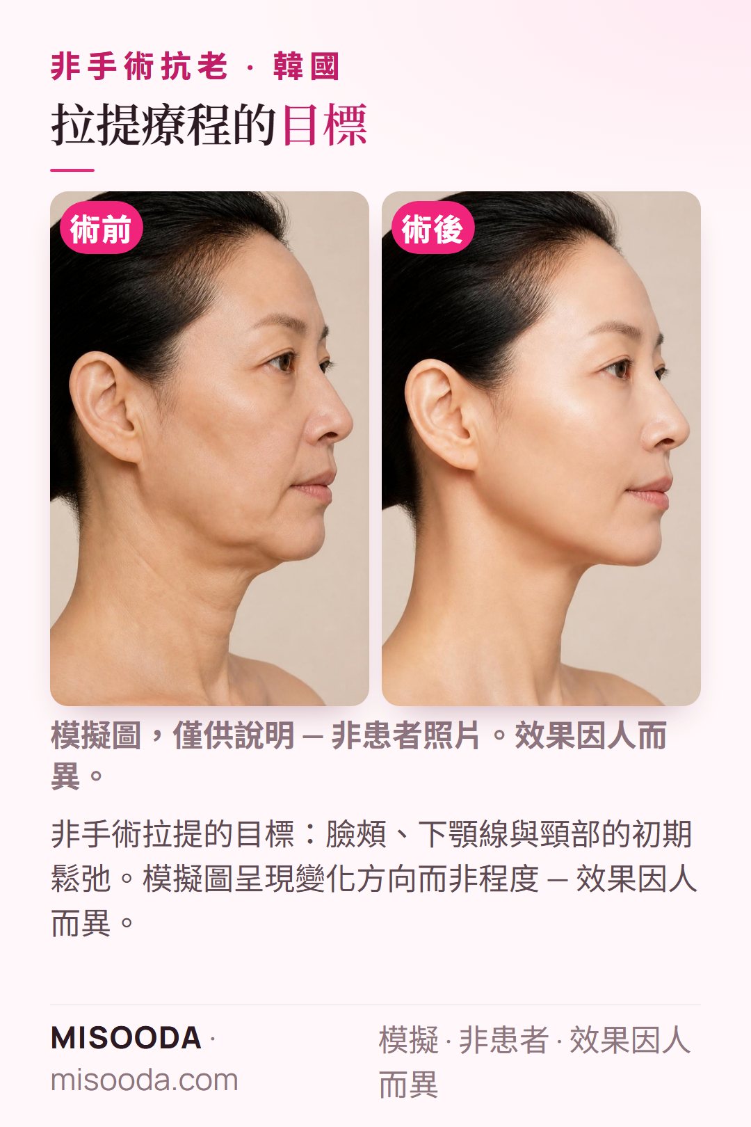 韓國非手術拉提常見目標示意圖 — 臉頰、下顎線與頸部的初期鬆弛 — 以模特兒模擬呈現,並非真實患者照片,僅呈現變化方向而非實際改善程度
