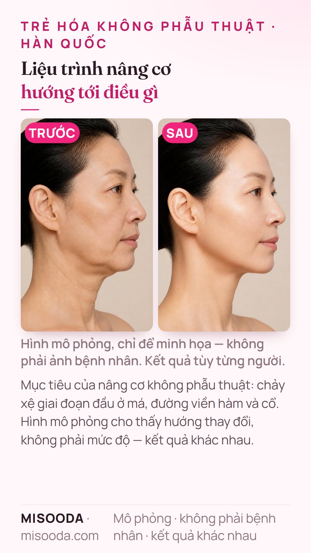 Minh họa mục tiêu thường gặp của nâng cơ không phẫu thuật tại Hàn Quốc — chảy xệ giai đoạn đầu ở má, đường viền hàm và cổ — mô phỏng trên người mẫu, không phải bệnh nhân; chỉ thể hiện hướng thay đổi