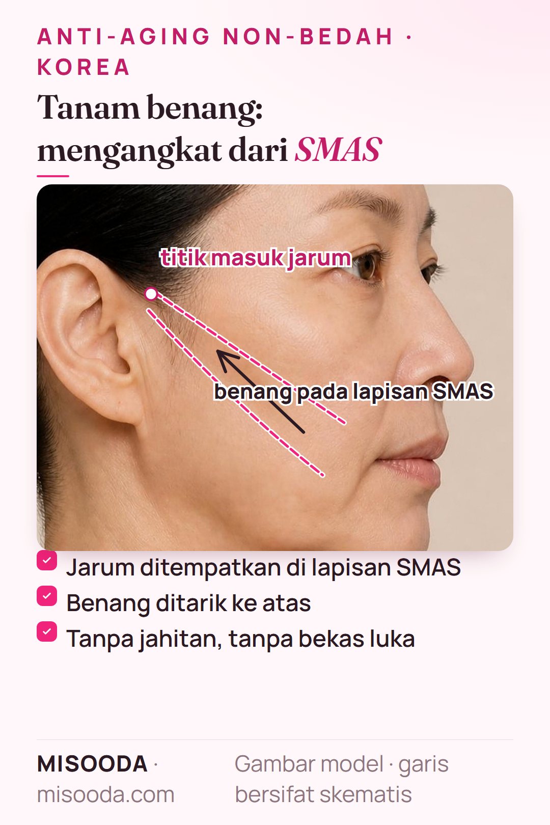 Tanam benang tanpa sayatan di Korea: jarum menempatkan benang berduri di lapisan SMAS dan menarik kulit pipi kendur ke atas, tanpa jahitan atau bekas luka
