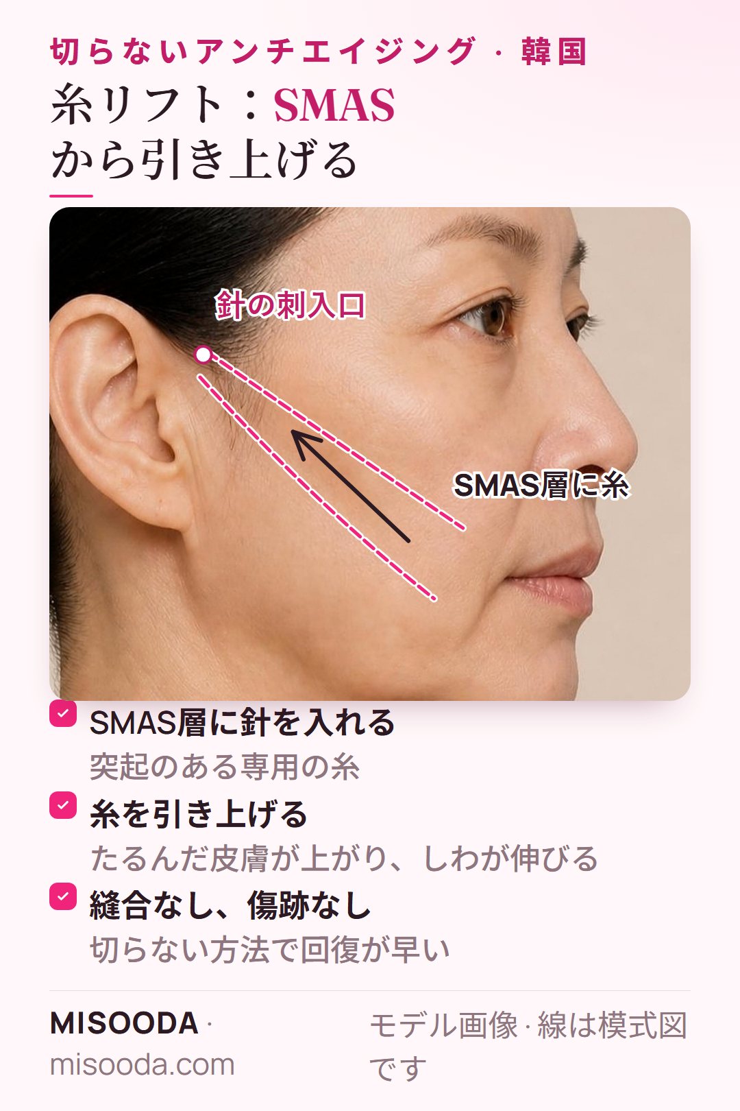 切らない糸リフト:針で突起のある糸をSMAS層に入れ、たるんだ頬の皮膚を引き上げる。縫合も傷跡もなし — 韓国 糸リフト