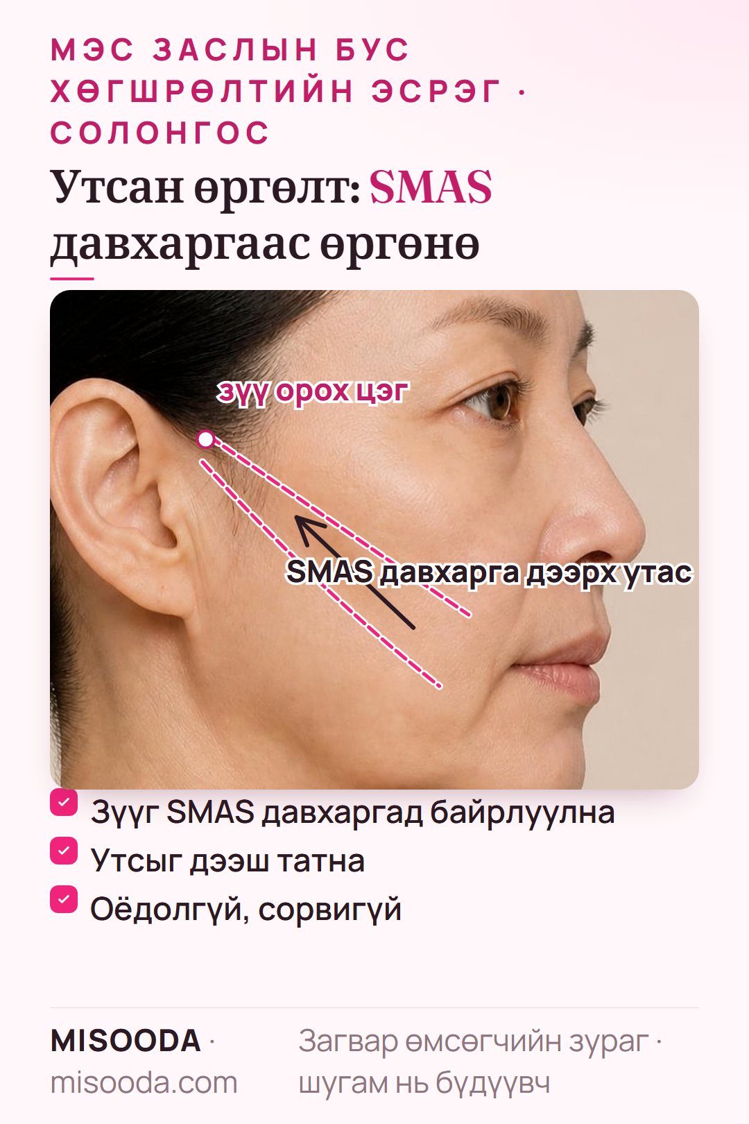 Зүсэлтгүй утсан өргөлт: зүүгээр дэгээтэй утсыг SMAS давхаргад байрлуулж унжсан хацрын арьсыг дээш татна, оёдол, сорвигүй
