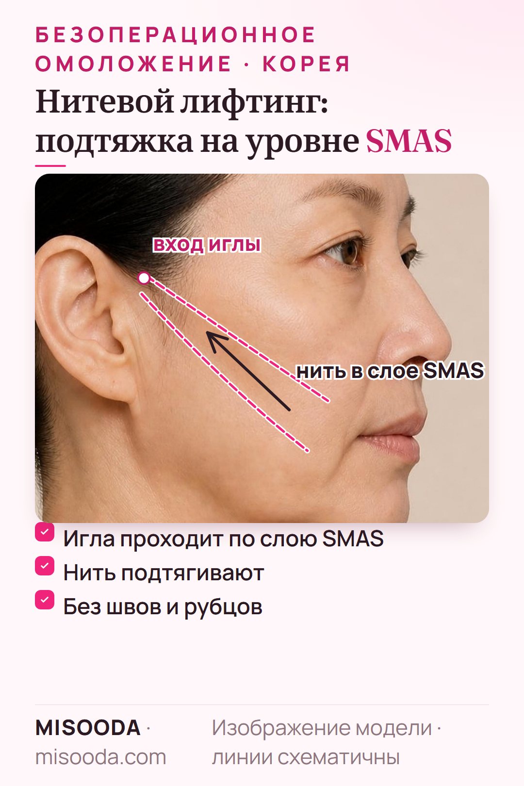 Нитевой лифтинг без разрезов: игла проводит нить с насечками по слою SMAS и подтягивает опущенную кожу щёк — без швов и рубцов