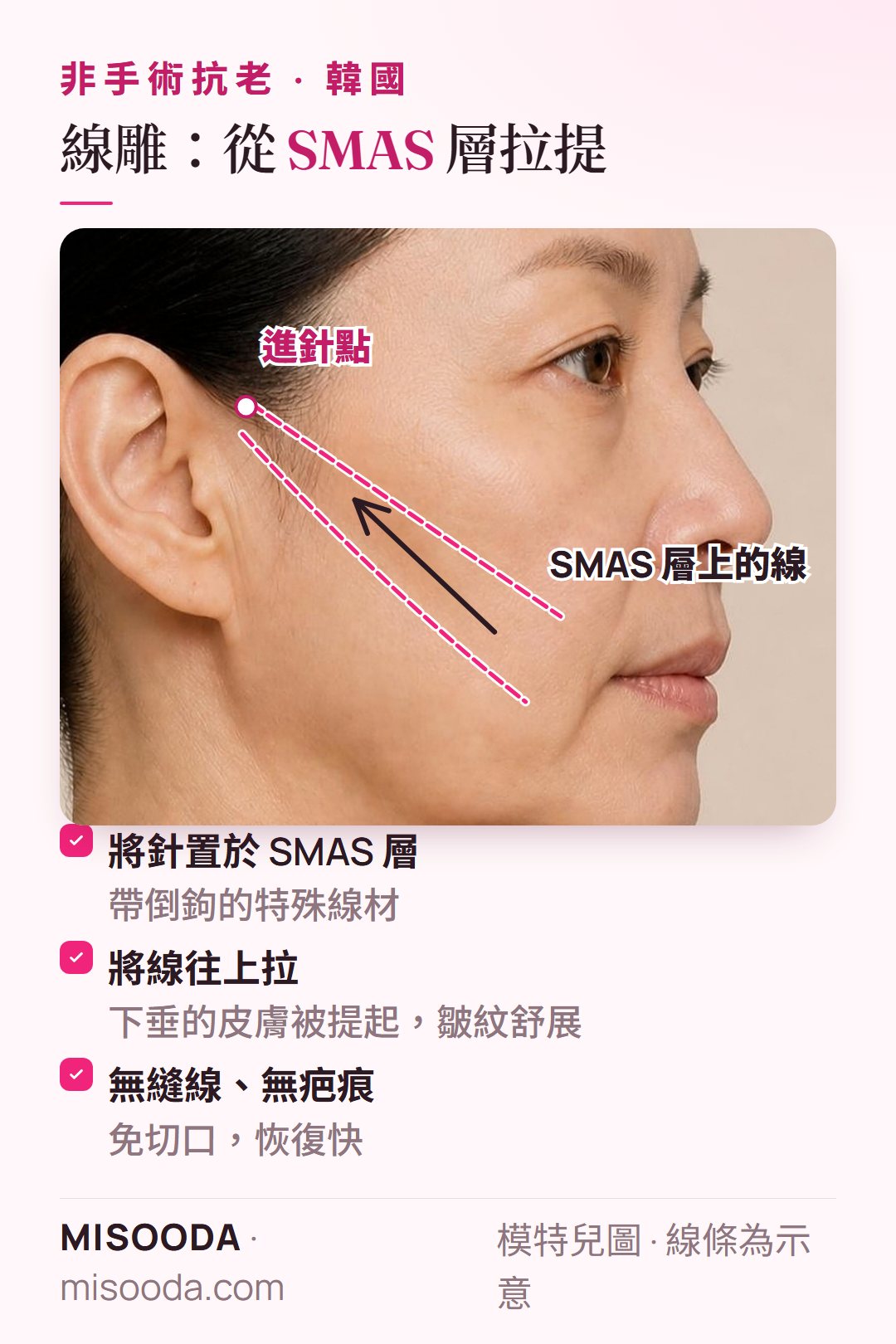 韓國 免切口線雕拉提:以針將帶倒鉤的線置於 SMAS 層,把下垂的臉頰皮膚往上拉,無縫線也無疤痕