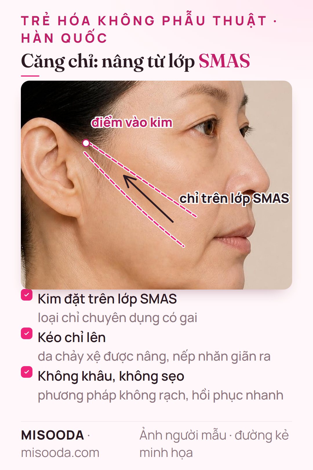 Căng chỉ không rạch: kim đặt chỉ có gai lên lớp SMAS và kéo da má chảy xệ lên, không khâu, không để lại sẹo