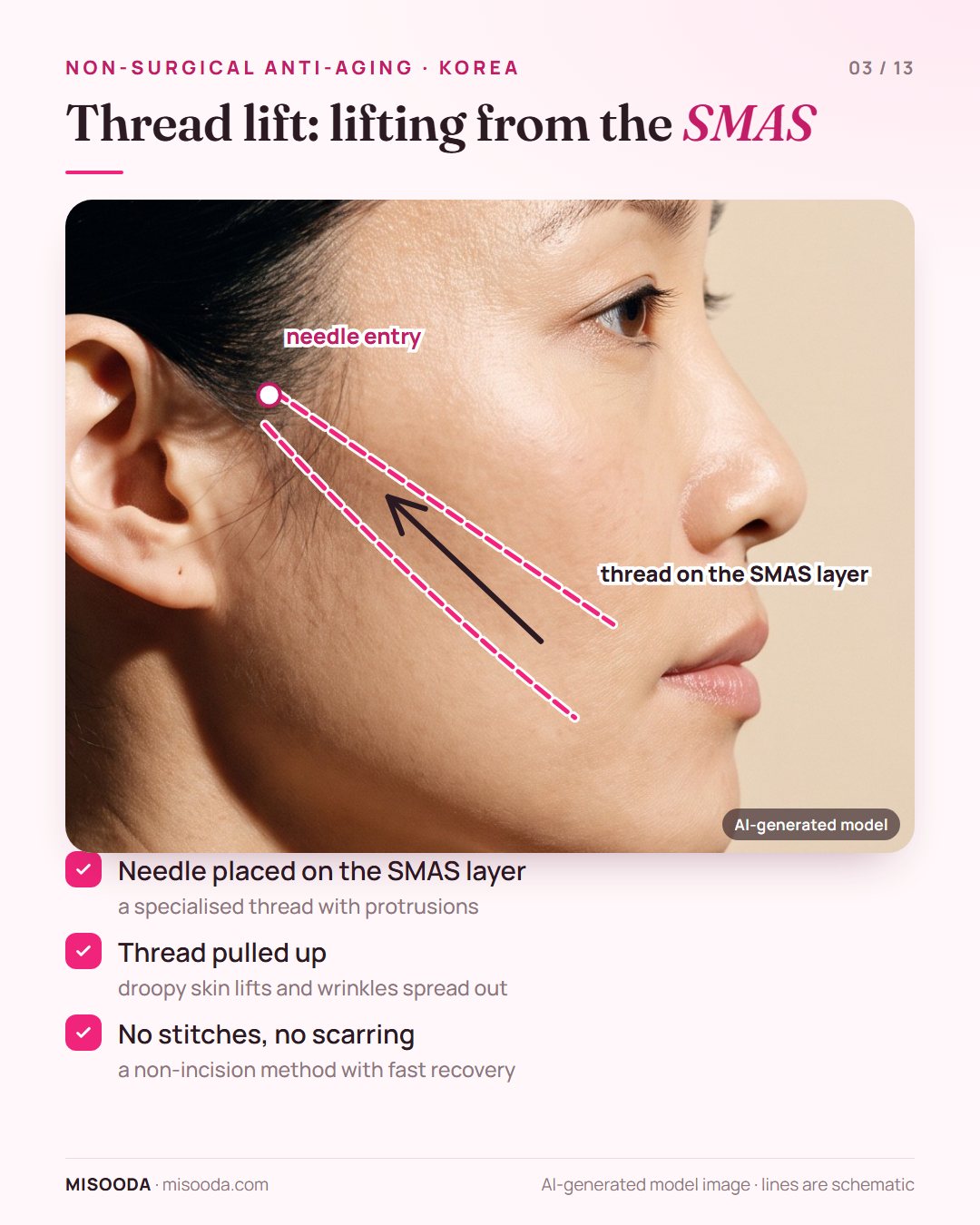 Non-incision thread lift: a needle places a thread with protrusions on the SMAS layer and pulls droopy cheek skin up, with no stitches or scarring