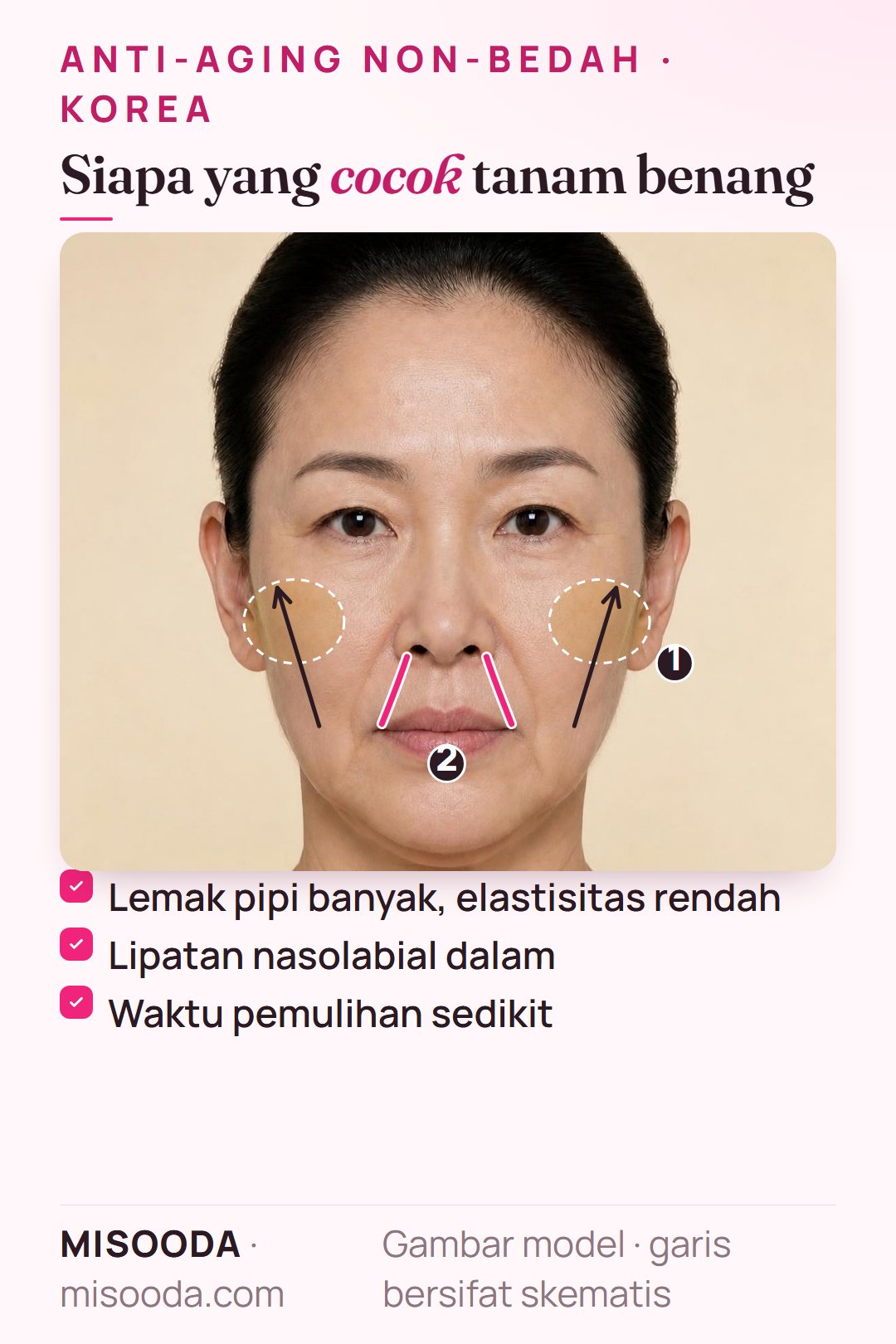 Kandidat tanam benang: lemak pipi banyak dengan elastisitas rendah di usia muda, lipatan nasolabial dalam dan pipi kendur, sedikit waktu untuk pemulihan bedah
