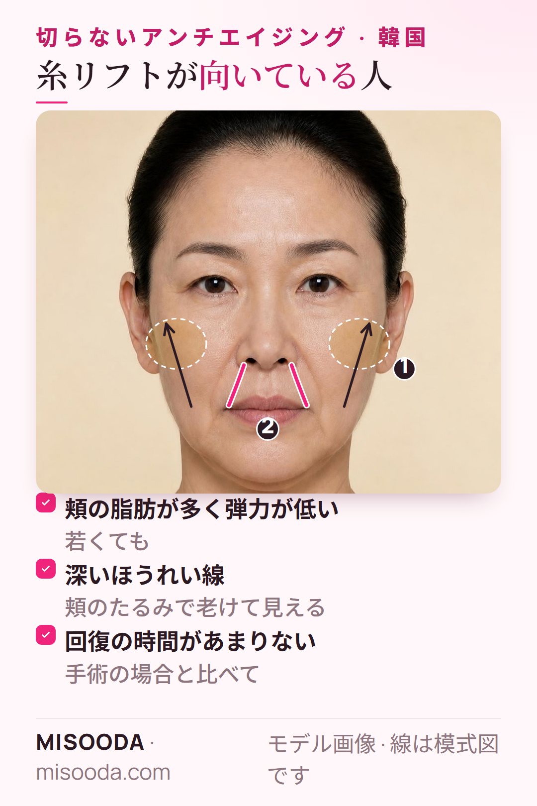 韓国 糸リフトが向いている人:若くても頬の脂肪が多く弾力が低い、深いほうれい線と頬のたるみ、手術の回復時間がとれない