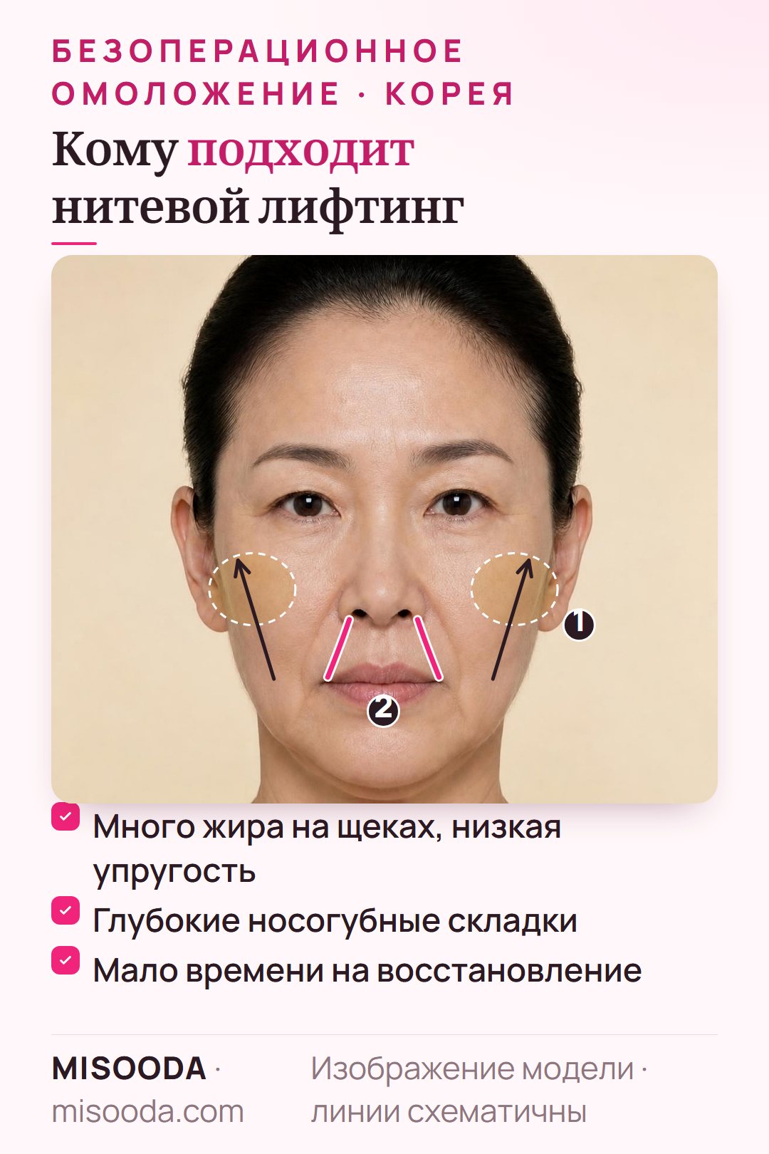 Кому подходит нитевой лифтинг: много жира на щеках и низкая упругость в молодом возрасте, глубокие носогубные складки и опущенные щёки, мало времени на восстановление
