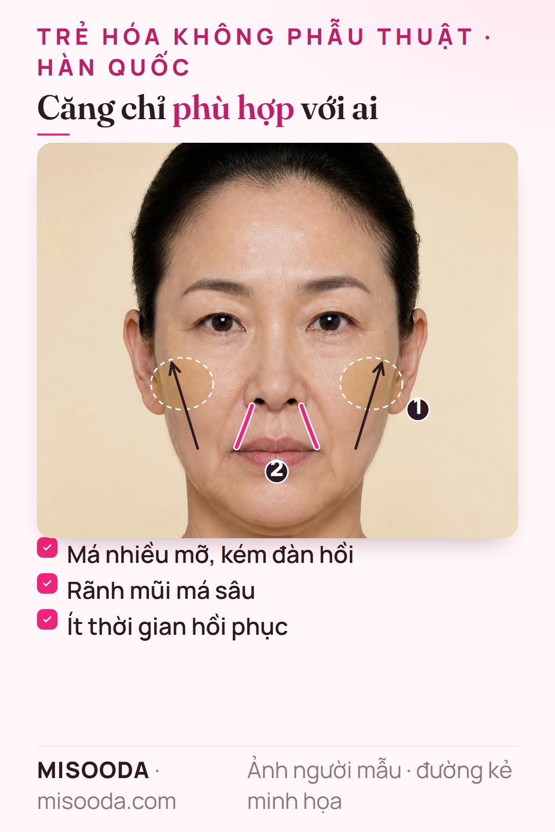 Ai phù hợp căng chỉ: má nhiều mỡ, kém đàn hồi dù còn trẻ, rãnh mũi má sâu và má chảy xệ, ít thời gian hồi phục sau phẫu thuật