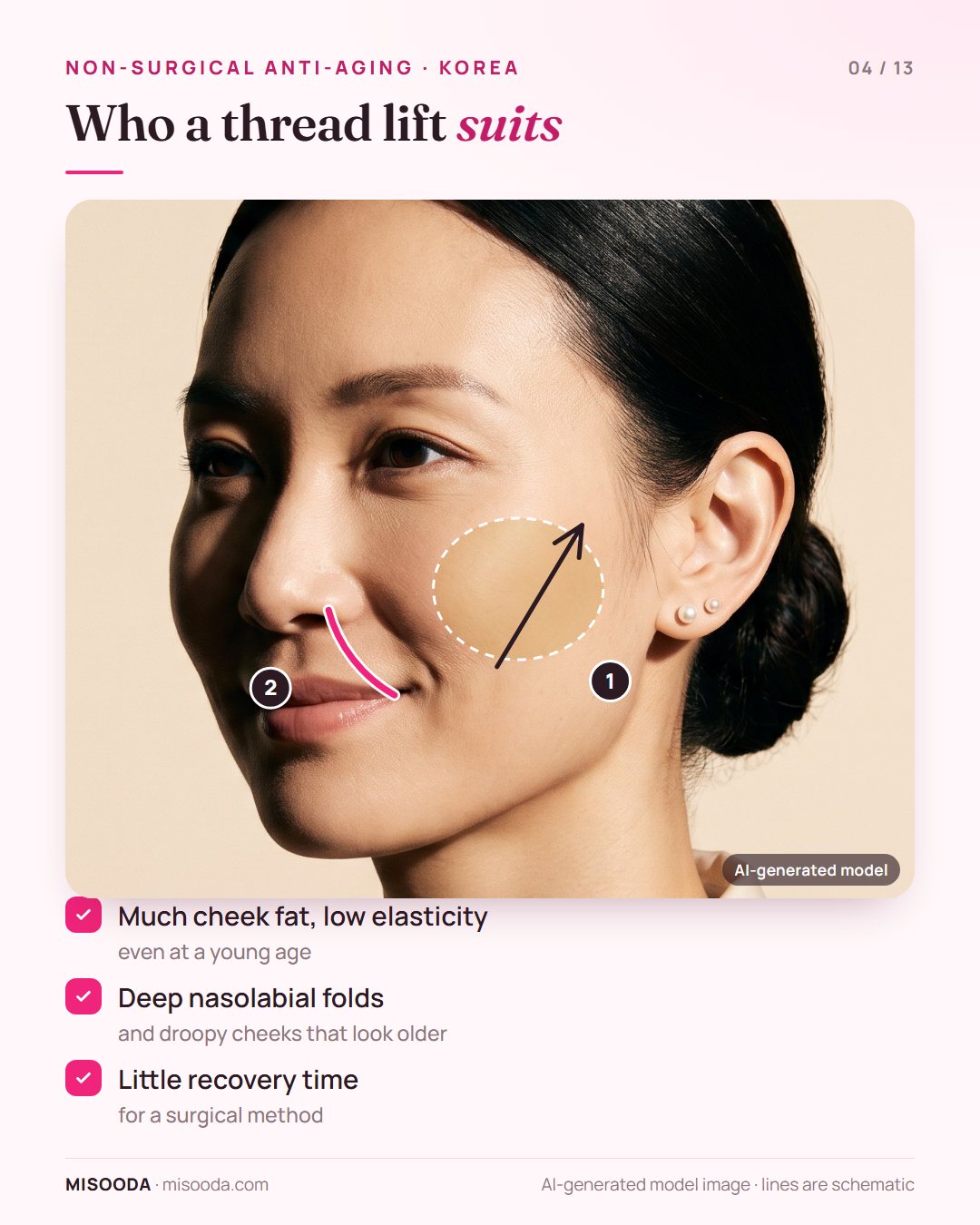 Thread lift candidates: much cheek fat with low elasticity at a young age, deep nasolabial folds and droopy cheeks, little time for surgical recovery