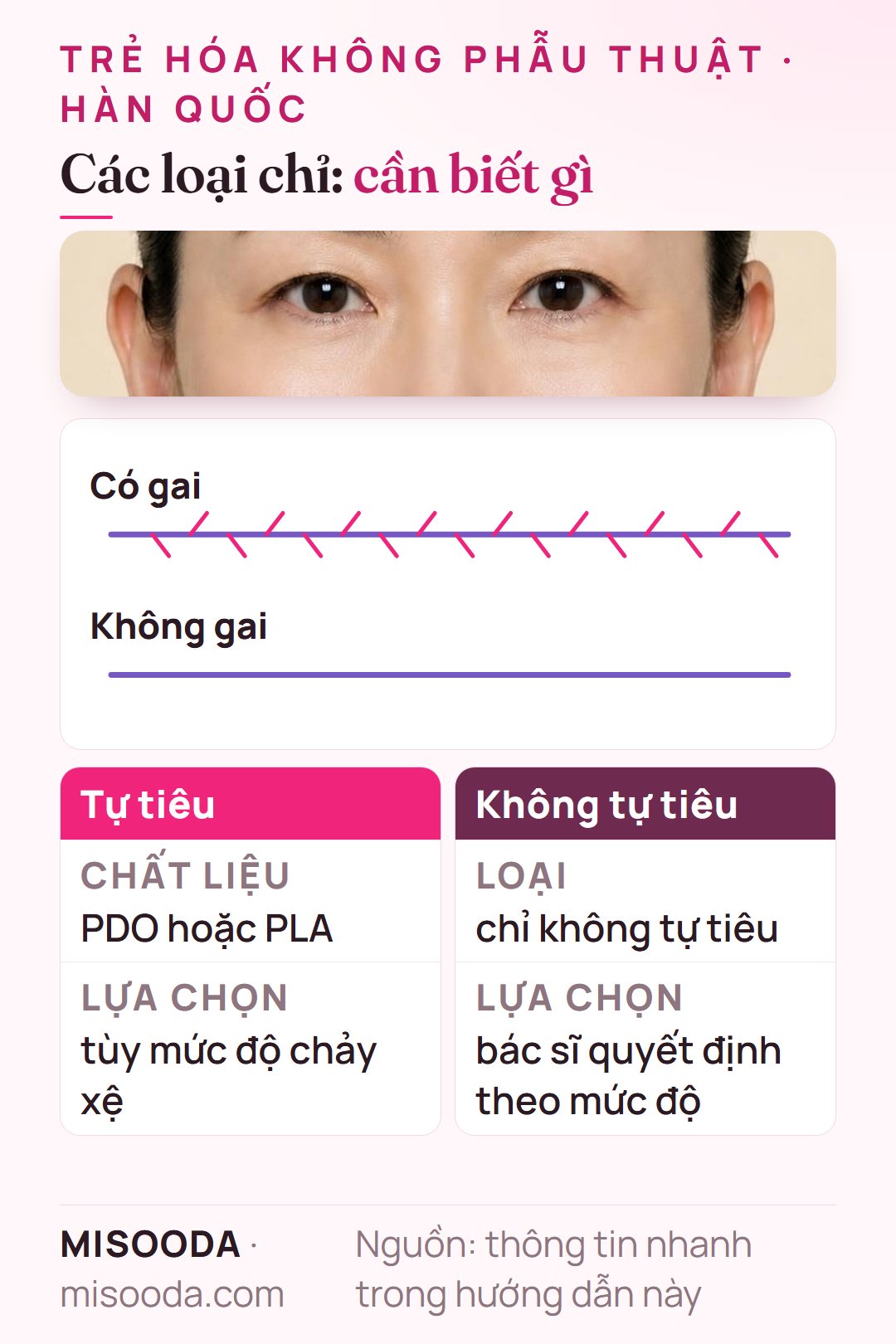 Các loại chỉ trẻ hóa: chỉ tự tiêu PDO hoặc PLA và chỉ không tự tiêu, chỉ có gai hoặc không gai, chọn theo mức độ chảy xệ