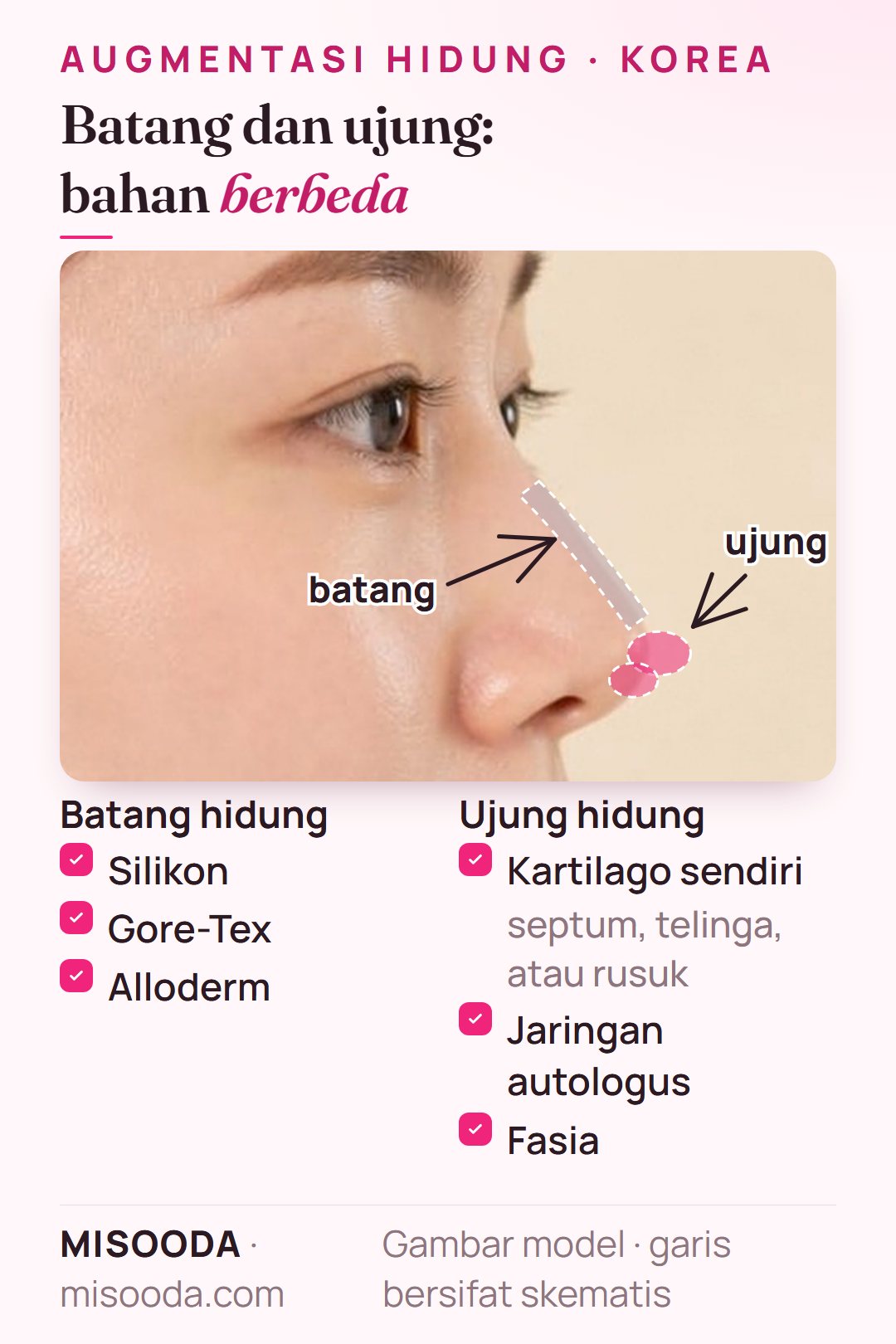 Bahan augmentasi hidung di Korea: silikon, Gore-Tex, atau Alloderm untuk batang hidung; kartilago septum, telinga, atau rusuk, jaringan autologus, atau fasia untuk ujung