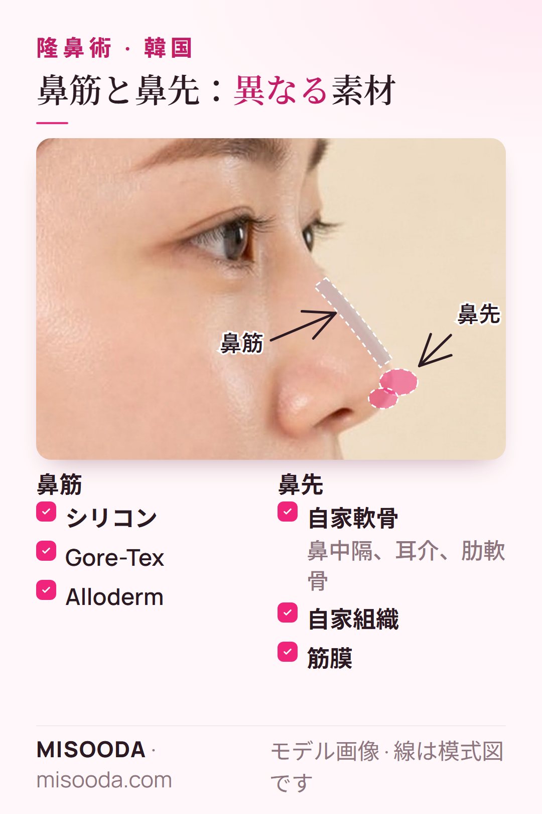 韓国 隆鼻術の素材:鼻筋にはシリコン、Gore-Tex、Alloderm、鼻先には鼻中隔・耳介・肋軟骨、自家組織、筋膜