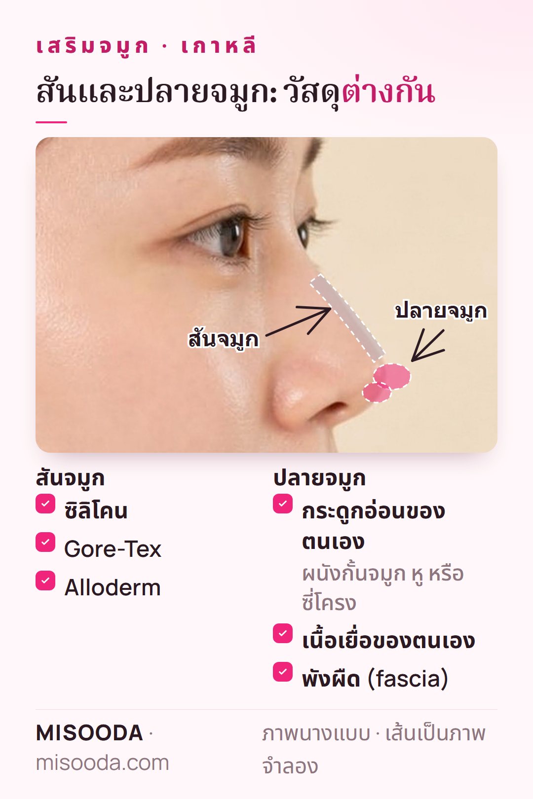 วัสดุเสริมจมูก เกาหลี: ซิลิโคน Gore-Tex หรือ Alloderm สำหรับสันจมูก กระดูกอ่อนผนังกั้นจมูก หู หรือซี่โครง เนื้อเยื่อตนเองหรือพังผืดสำหรับปลายจมูก