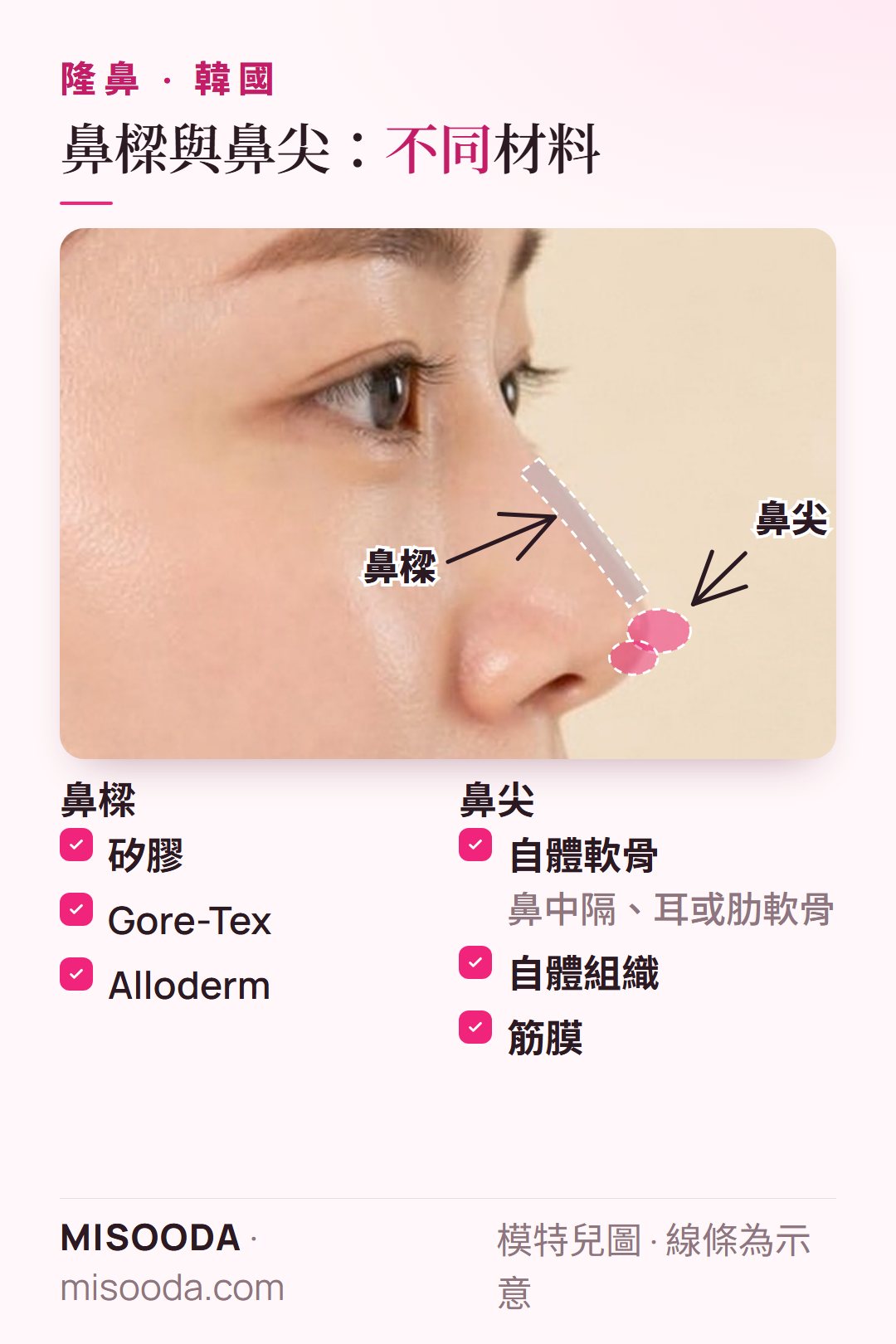 韓國 隆鼻材料:鼻樑用矽膠、Gore-Tex 或 Alloderm;鼻尖用鼻中隔、耳或肋軟骨、自體組織或筋膜
