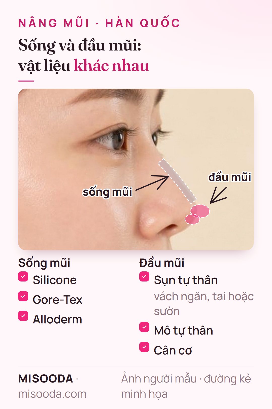 Vật liệu nâng mũi: silicone, Gore-Tex hoặc Alloderm cho sống mũi; sụn vách ngăn, tai hoặc sườn, mô tự thân hay cân cơ cho đầu mũi