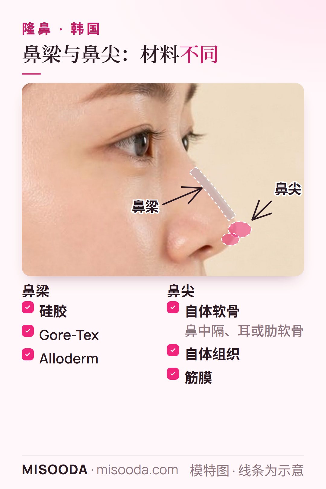 韩国 隆鼻材料:鼻梁用硅胶、Gore-Tex 或 Alloderm;鼻尖用鼻中隔、耳或肋软骨、自体组织或筋膜