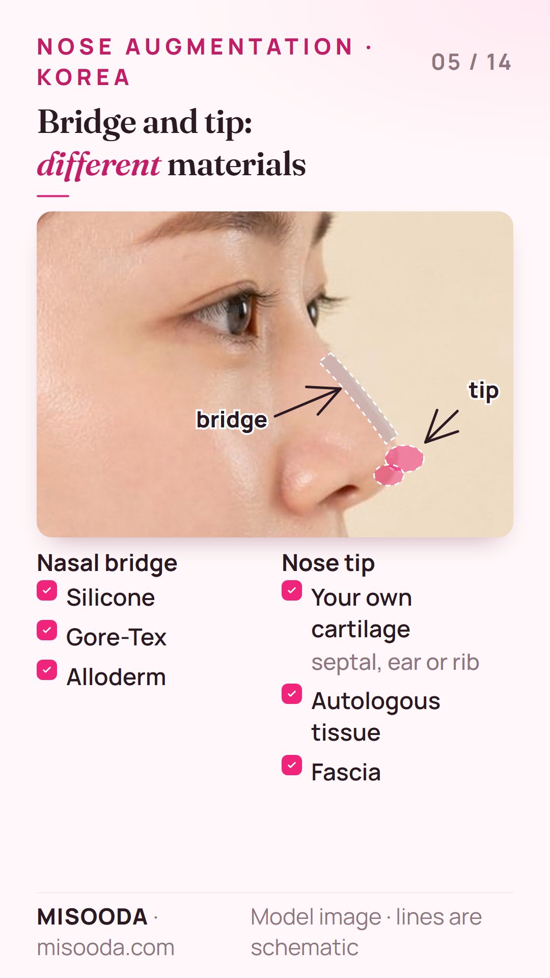 Nose augmentation materials: silicone, Gore-Tex or Alloderm for the nasal bridge; septal, ear or rib cartilage, autologous tissue or fascia for the nose tip