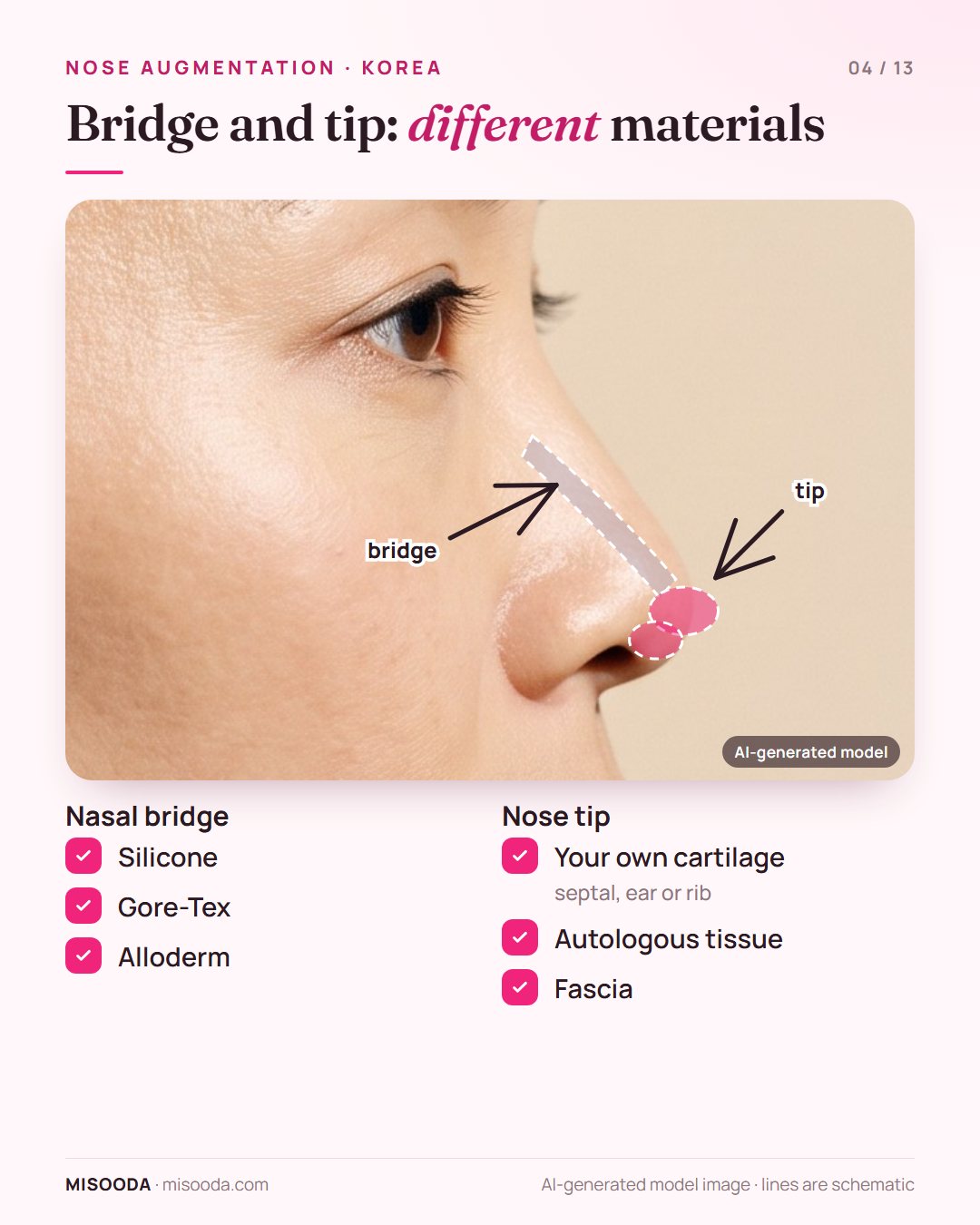 Nose augmentation materials: silicone, Gore-Tex or Alloderm for the nasal bridge; septal, ear or rib cartilage, autologous tissue or fascia for the nose tip