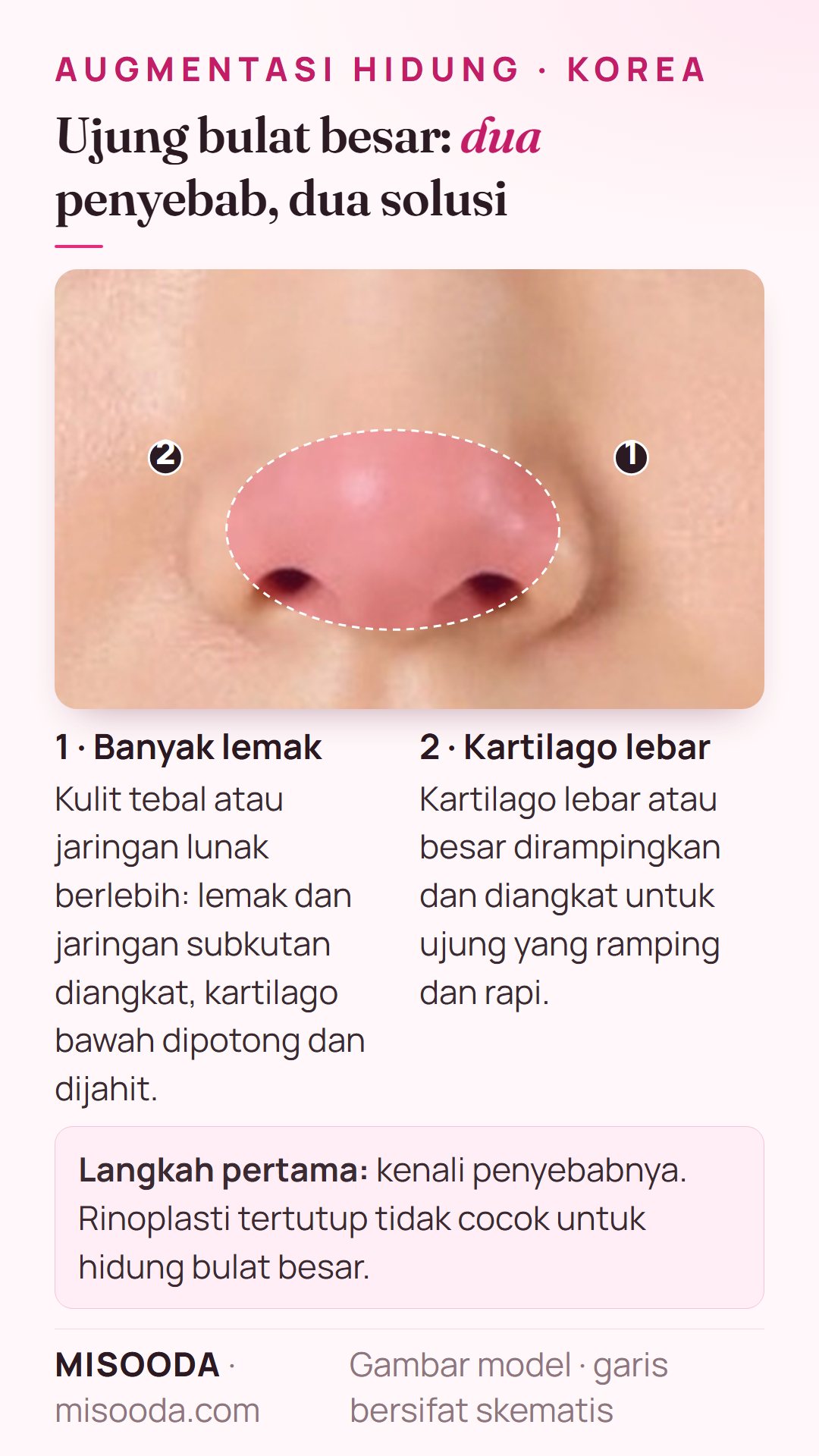 Koreksi ujung hidung bulat besar: lemak berlebih dan kulit tebal diangkat lalu kartilago dijahit, atau kartilago lebar dirampingkan dan diangkat untuk ujung ramping