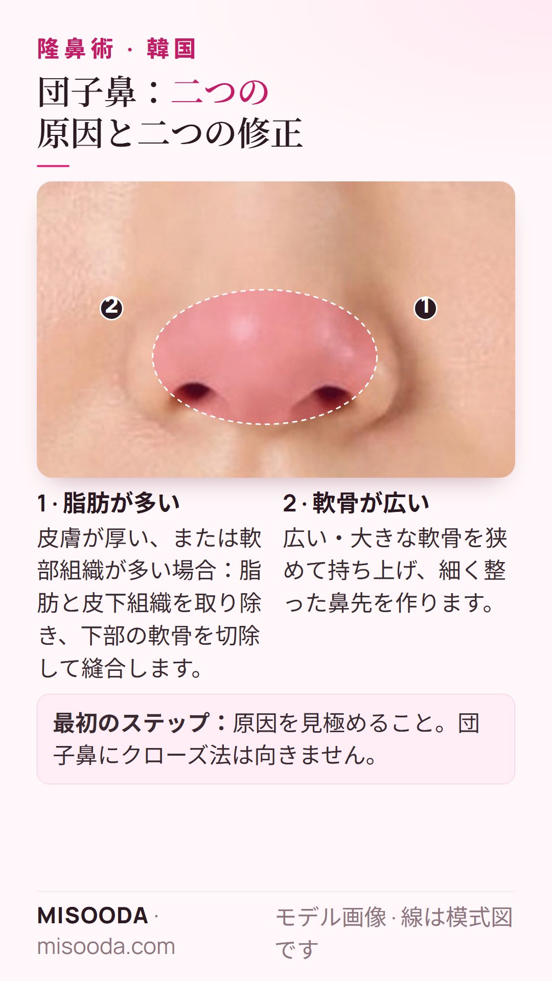 団子鼻の修正:余分な脂肪と厚い皮膚を取り除いて軟骨を縫合、または広い軟骨を狭めて持ち上げ細い鼻先に — 韓国 鼻整形