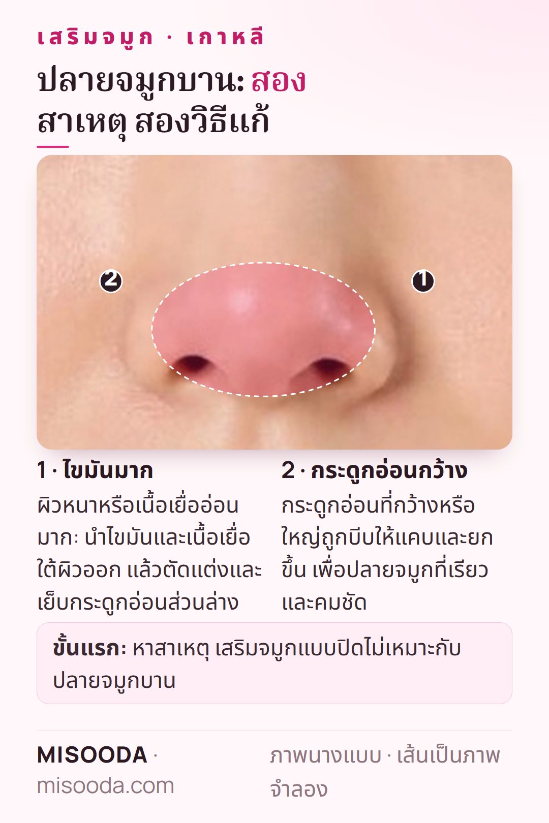 แก้ปลายจมูกบาน เกาหลี: นำไขมันส่วนเกินและผิวหนาออกแล้วเย็บกระดูกอ่อน หรือบีบกระดูกอ่อนที่กว้างให้แคบและยกขึ้นเพื่อปลายจมูกเรียว