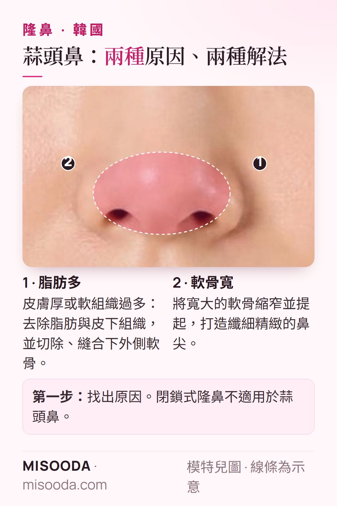 韓國 蒜頭鼻矯正:去除多餘脂肪與厚皮下組織並縫合軟骨,或縮窄並提起寬大的軟骨,打造纖細鼻尖
