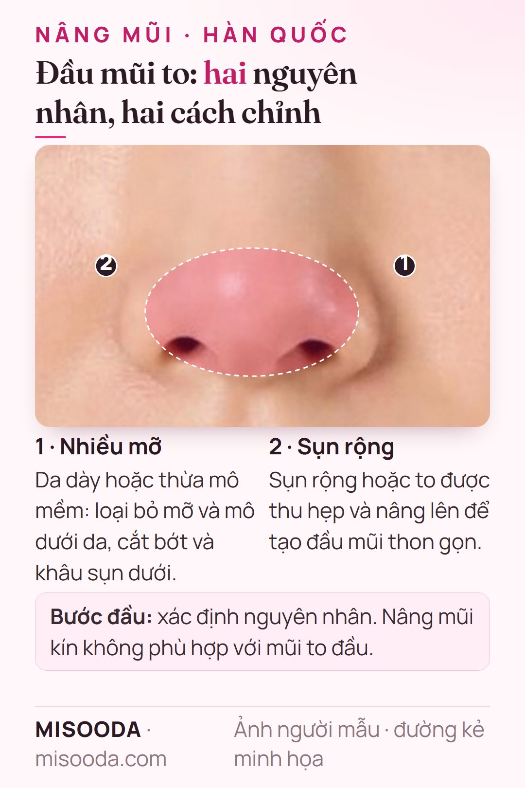 Chỉnh đầu mũi to: loại bỏ mỡ thừa, da dày và khâu sụn, hoặc thu hẹp và nâng sụn rộng để có đầu mũi thon gọn