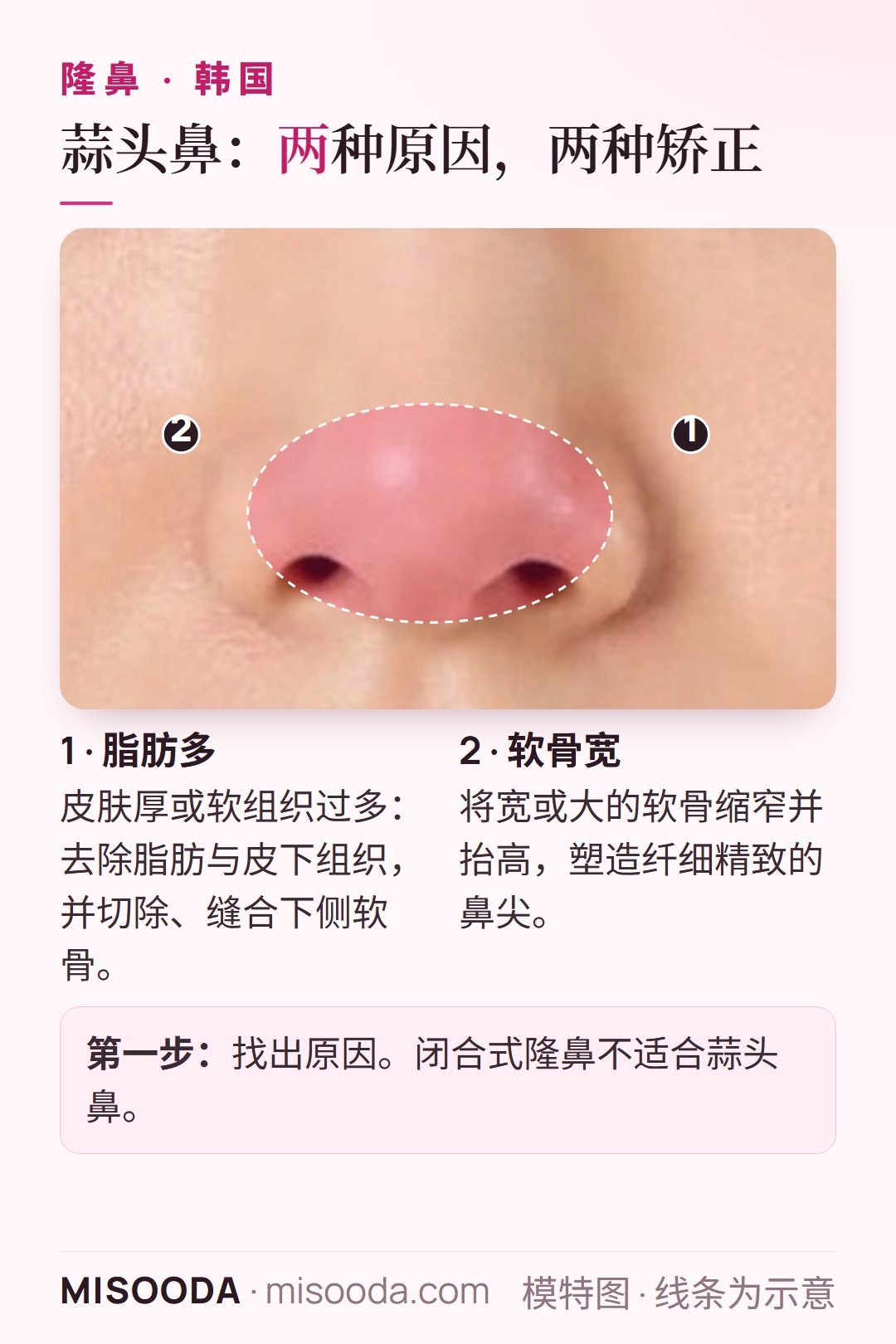 韩国 蒜头鼻鼻尖矫正:去除多余脂肪与厚皮下组织并缝合软骨,或将宽软骨缩窄抬高,打造纤细鼻尖