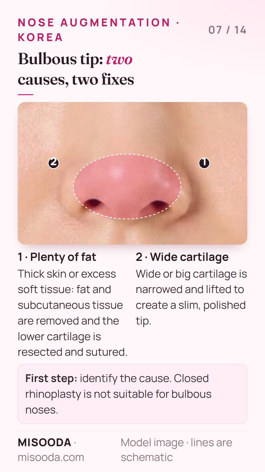 Bulbous nose tip correction: excess fat and thick skin removed and cartilage sutured, or wide cartilage narrowed and lifted for a slim tip