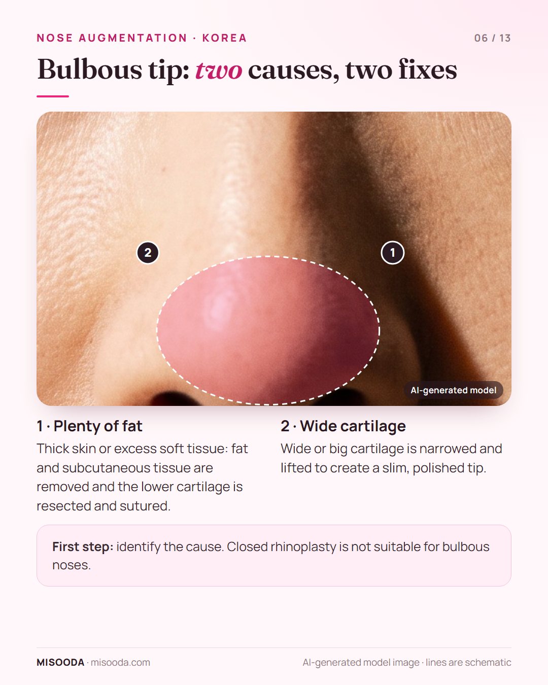 Bulbous nose tip correction: excess fat and thick skin removed and cartilage sutured, or wide cartilage narrowed and lifted for a slim tip