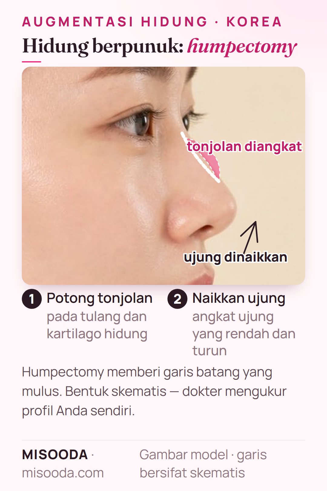 Humpectomy hidung berpunuk di Korea: tonjolan pada tulang dan kartilago hidung dipotong dan ujung hidung yang rendah dinaikkan untuk garis batang yang mulus