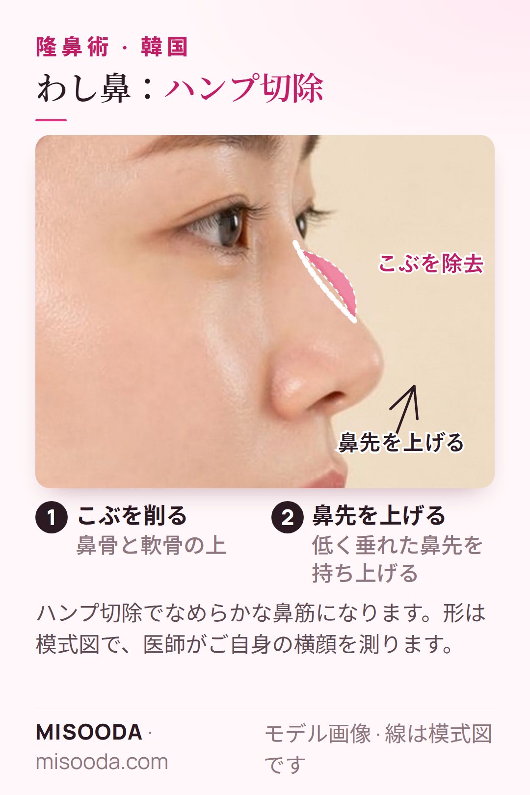 韓国 わし鼻のハンプ切除:鼻骨と軟骨のこぶを削り、低く垂れた鼻先を上げてなめらかな鼻筋に
