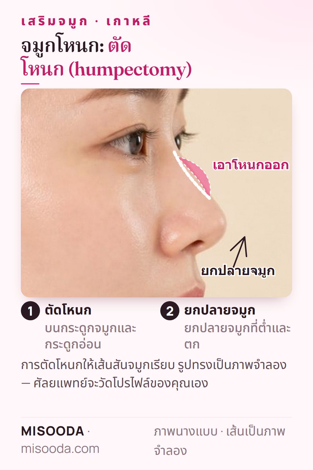 ตัดโหนกจมูก (humpectomy) เกาหลี: ตัดโหนกบนกระดูกจมูกและกระดูกอ่อน และยกปลายจมูกที่ต่ำและตกขึ้นเพื่อเส้นสันจมูกที่เรียบ