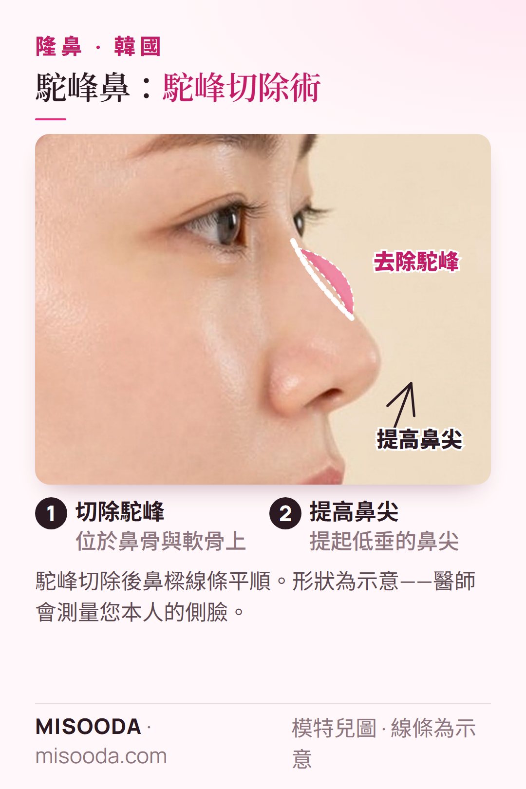韓國 駝峰鼻駝峰切除術:切除鼻骨與軟骨上的駝峰,並提起低垂的鼻尖,讓鼻樑線條平順