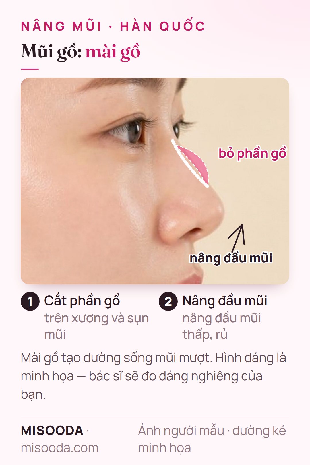 Mài gồ mũi tại Hàn Quốc: cắt phần gồ trên xương và sụn mũi, nâng đầu mũi thấp và rủ để có đường sống mũi mượt