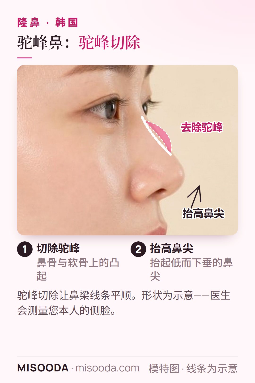 韩国 驼峰鼻驼峰切除:切除鼻骨与软骨上的凸起,并抬高低而下垂的鼻尖,让鼻梁线条平顺