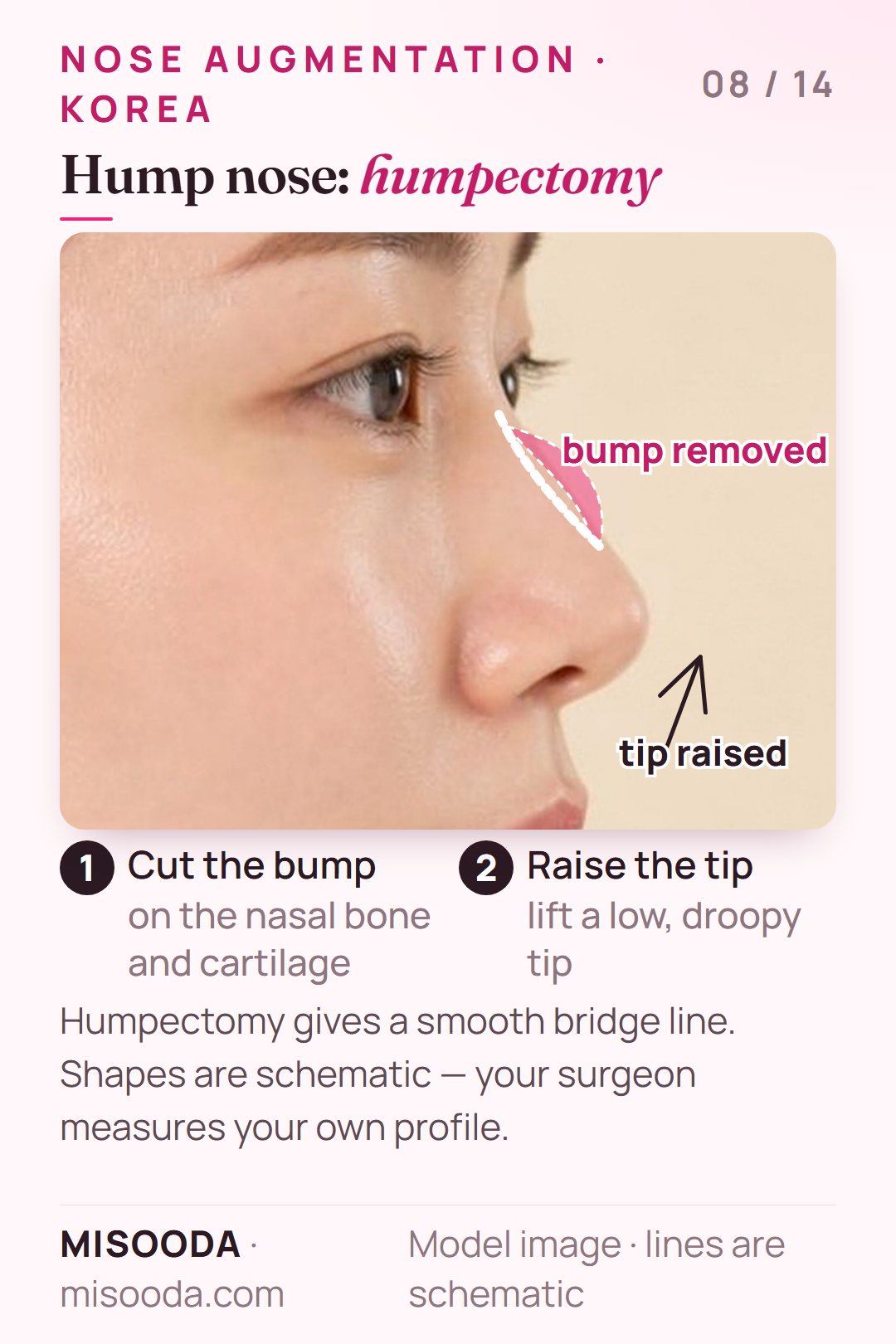 Hump nose humpectomy in Korea: the bump on the nasal bone and cartilage is cut and a low, droopy nose tip is raised for a smooth bridge line