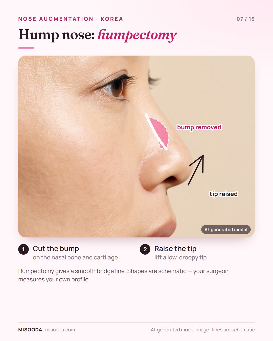 Hump nose humpectomy in Korea: the bump on the nasal bone and cartilage is cut and a low, droopy nose tip is raised for a smooth bridge line