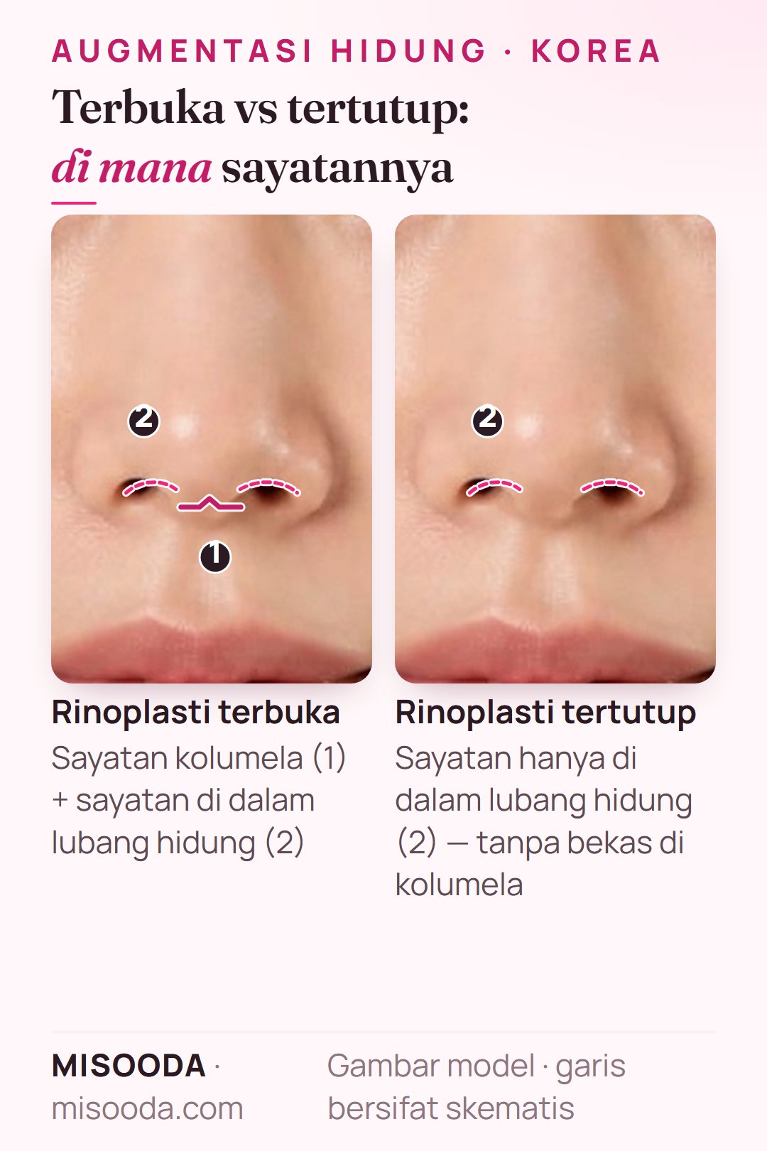 Sayatan rinoplasti terbuka vs tertutup untuk operasi hidung di Korea: terbuka menambah sayatan kolumela pada sayatan di dalam lubang hidung; tertutup hanya di lubang hidung