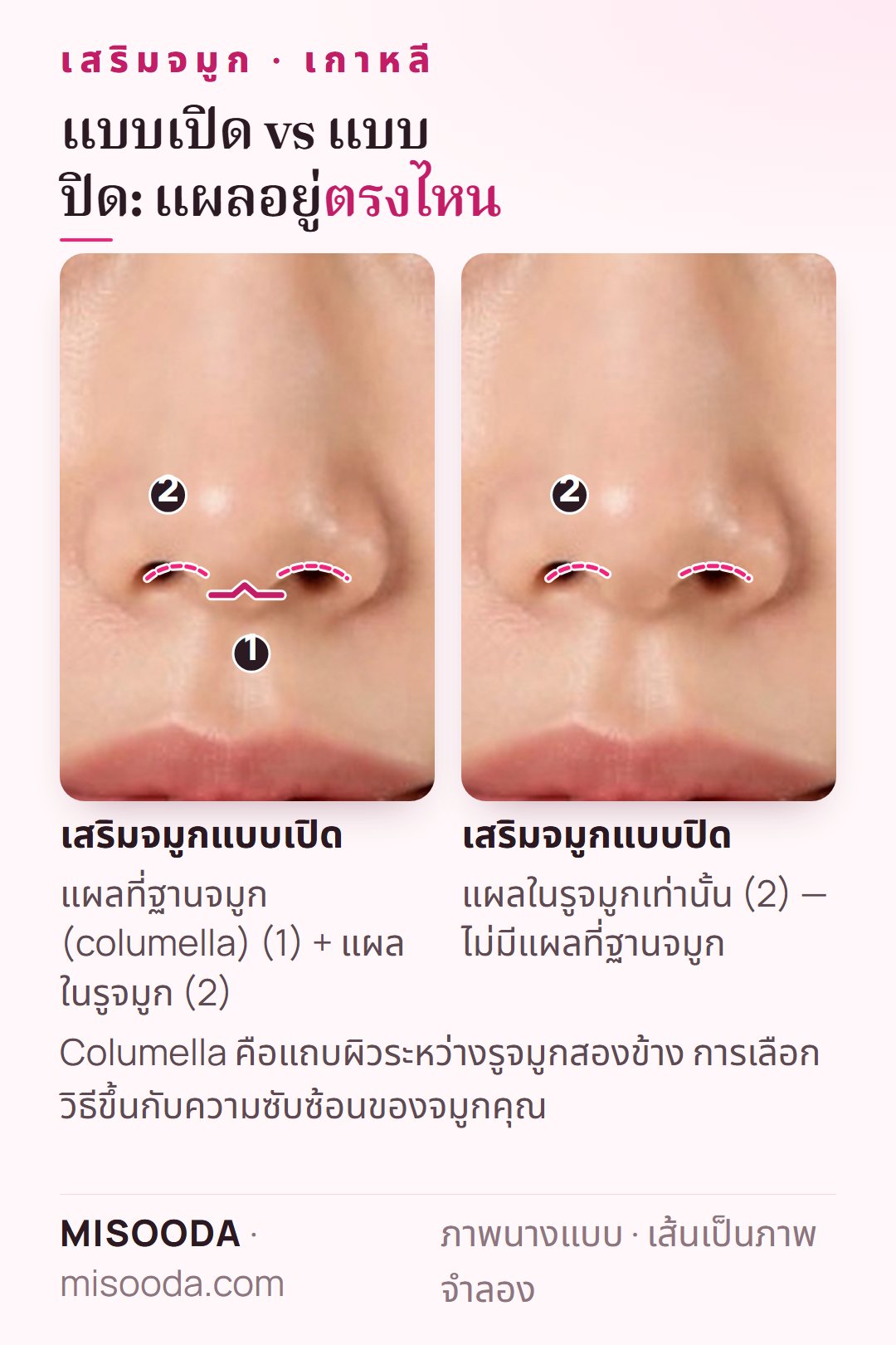 แผลเสริมจมูกแบบเปิด vs แบบปิด เกาหลี: แบบเปิดเพิ่มแผลที่ฐานจมูก (columella) กับแผลในรูจมูก แบบปิดใช้แผลในรูจมูกเท่านั้น