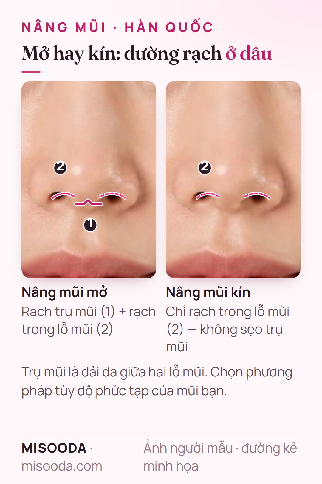 Đường rạch nâng mũi mở và kín tại Hàn Quốc: nâng mũi mở thêm đường rạch trụ mũi ngoài đường rạch trong lỗ mũi; nâng mũi kín chỉ rạch trong lỗ mũi