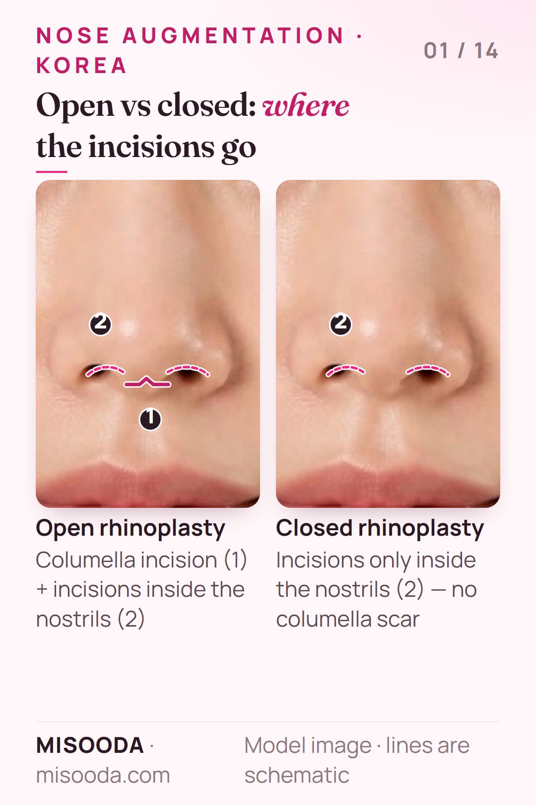 Open vs closed rhinoplasty incisions for nose augmentation in Korea: open adds a columella incision to incisions inside the nostrils; closed uses only the nostrils
