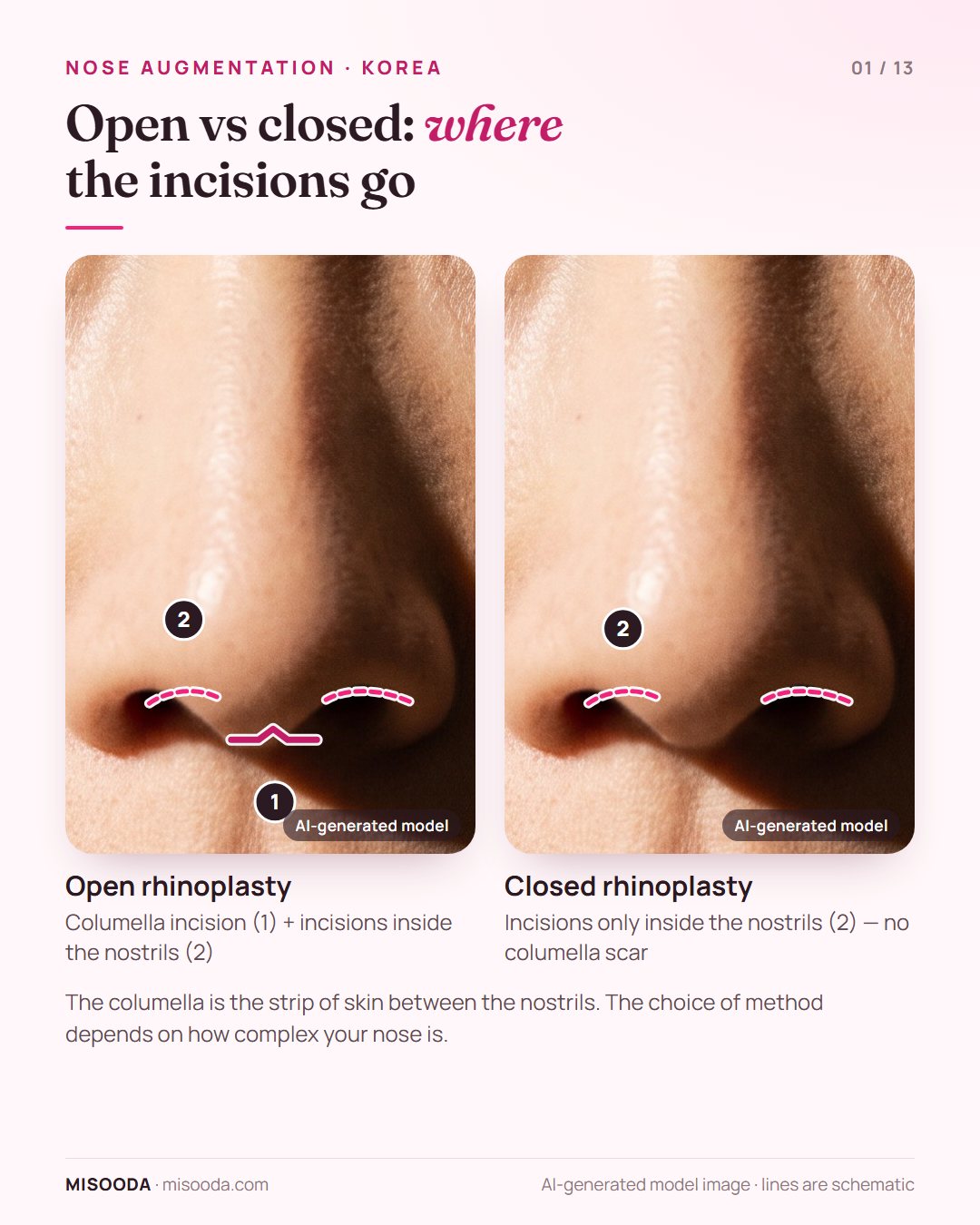 Open vs closed rhinoplasty incisions for nose augmentation in Korea: open adds a columella incision to incisions inside the nostrils; closed uses only the nostrils