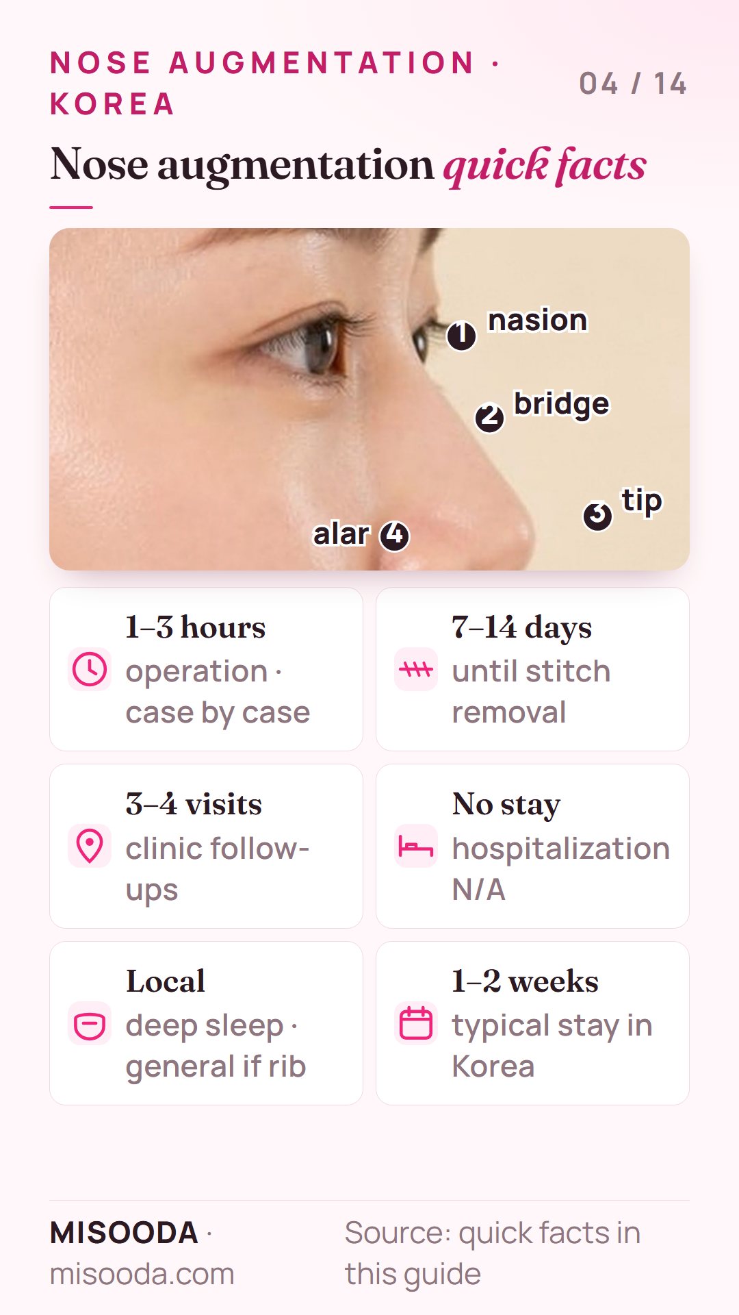 Nose augmentation quick facts: nasion, bridge, tip and alar surgery sites, 1–3 hours surgery, stitch removal after 7–14 days, 3–4 clinic visits, 1–2 week stay