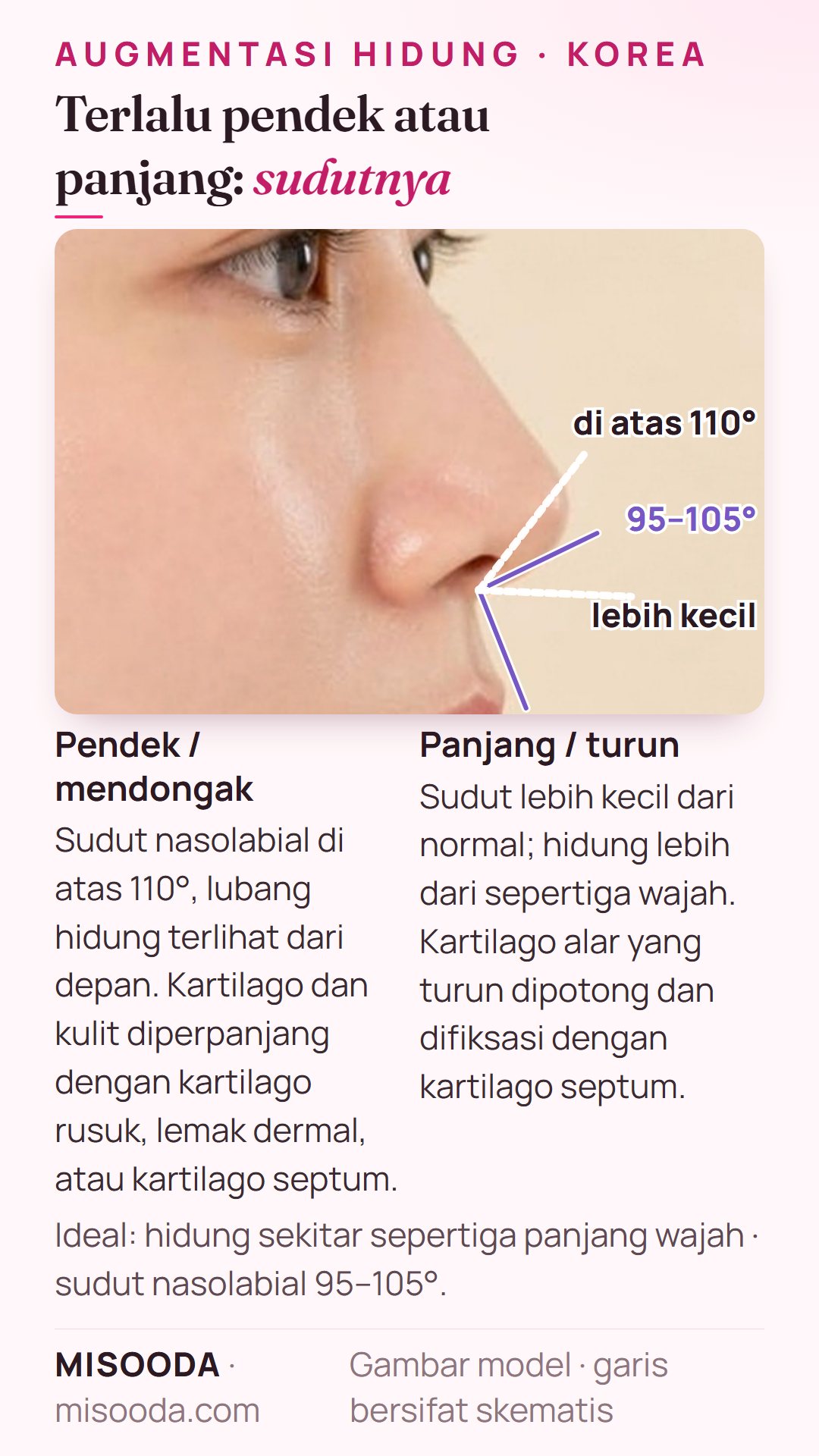 Koreksi hidung pendek vs panjang: sudut nasolabial ideal 95–105°, di atas 110° tampak mendongak; hidung sekitar sepertiga wajah; kartilago rusuk, septum, atau lemak dermal