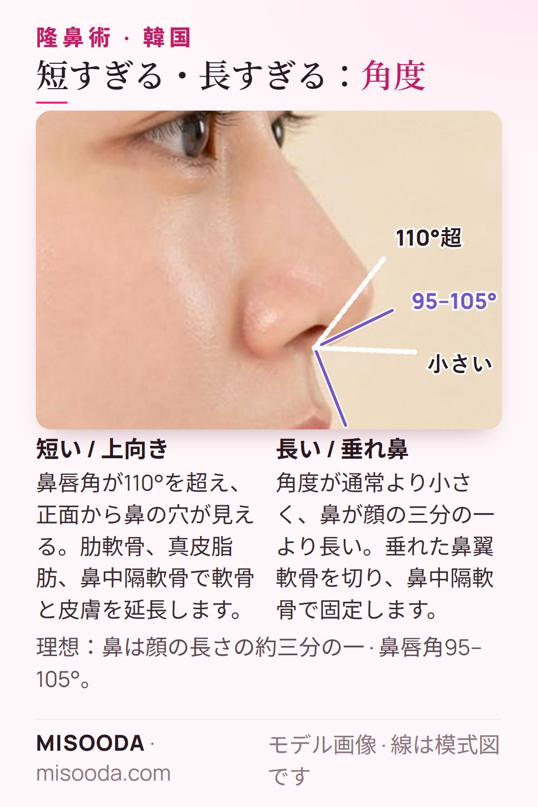 短い鼻と長い鼻の修正:理想の鼻唇角は95–105°、110°超は上向きに見える。鼻は顔の約三分の一。肋軟骨、鼻中隔軟骨、真皮脂肪 — 韓国 鼻整形