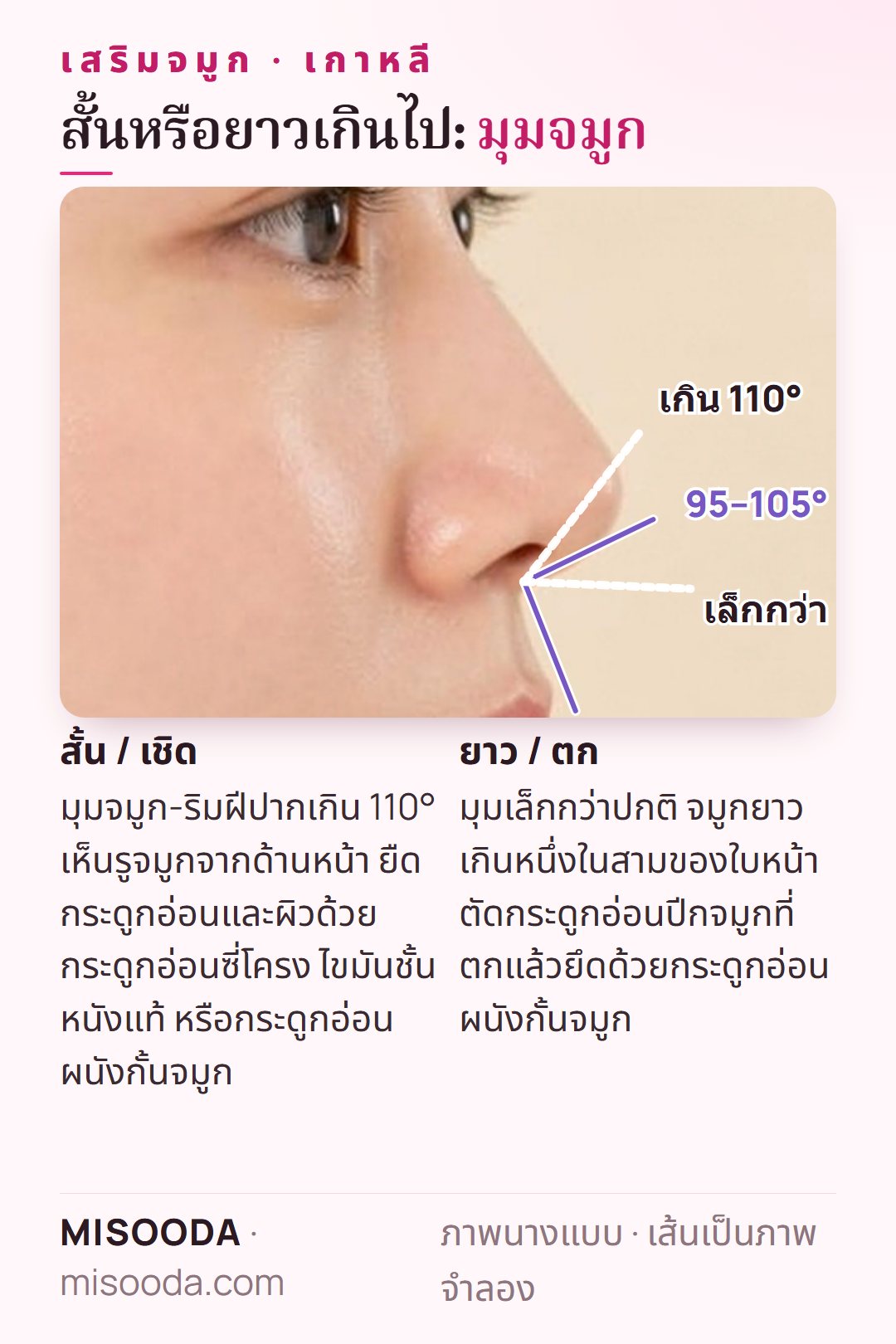 แก้จมูกสั้น vs ยาว เกาหลี: มุมจมูก-ริมฝีปากในอุดมคติ 95–105° เกิน 110° ดูเชิด จมูกยาวราวหนึ่งในสามของใบหน้า ใช้กระดูกอ่อนซี่โครง ผนังกั้นจมูก หรือไขมันหนังแท้