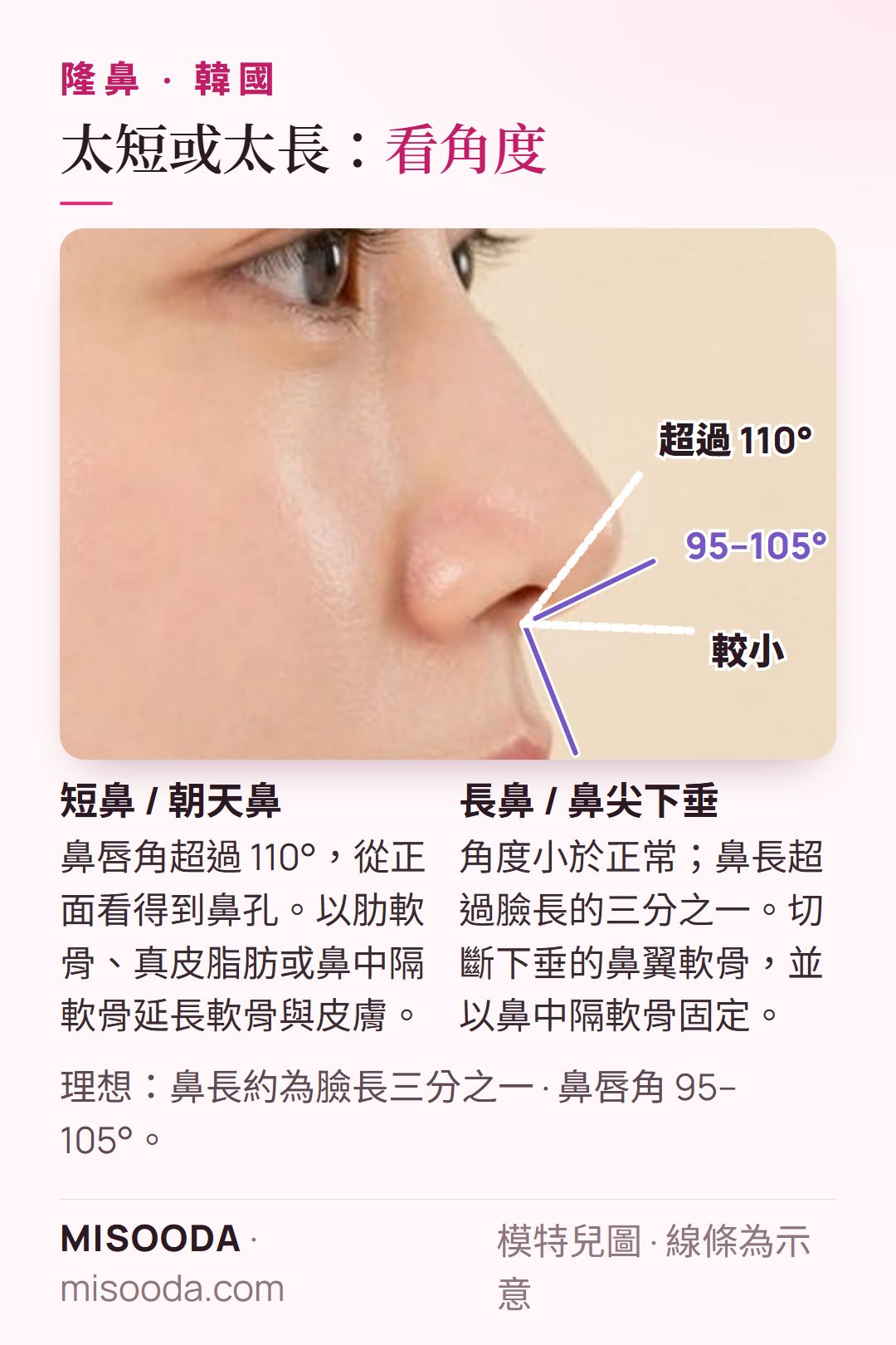 韓國 短鼻 vs 長鼻矯正:理想鼻唇角 95–105°,超過 110° 顯得朝天;鼻長約為臉長三分之一;使用肋軟骨、鼻中隔軟骨或真皮脂肪